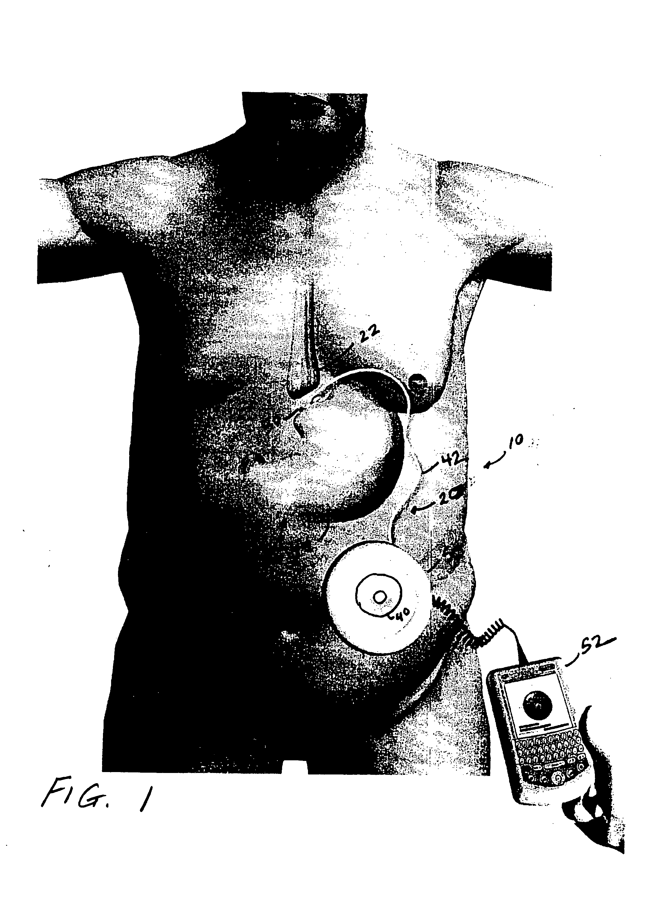 Bi-directional infuser pump with volume braking for hydraulically controlling an adjustable gastric band