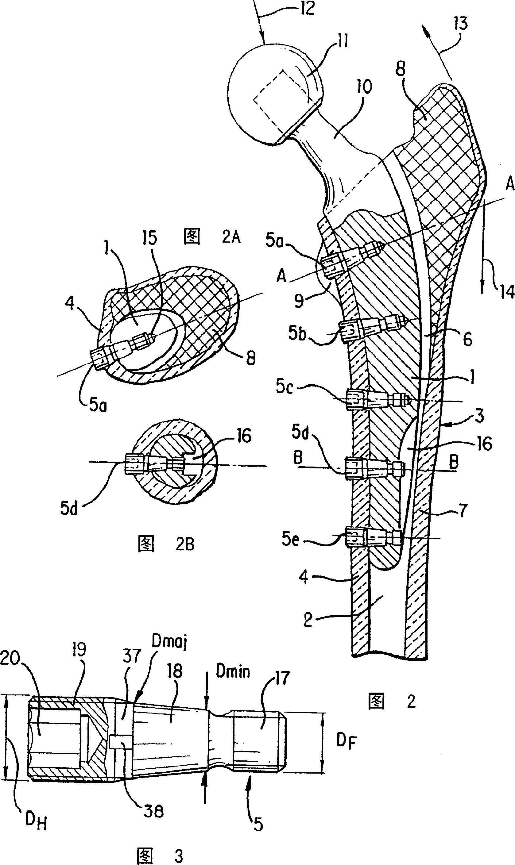 Screw anchored joint prosthesis