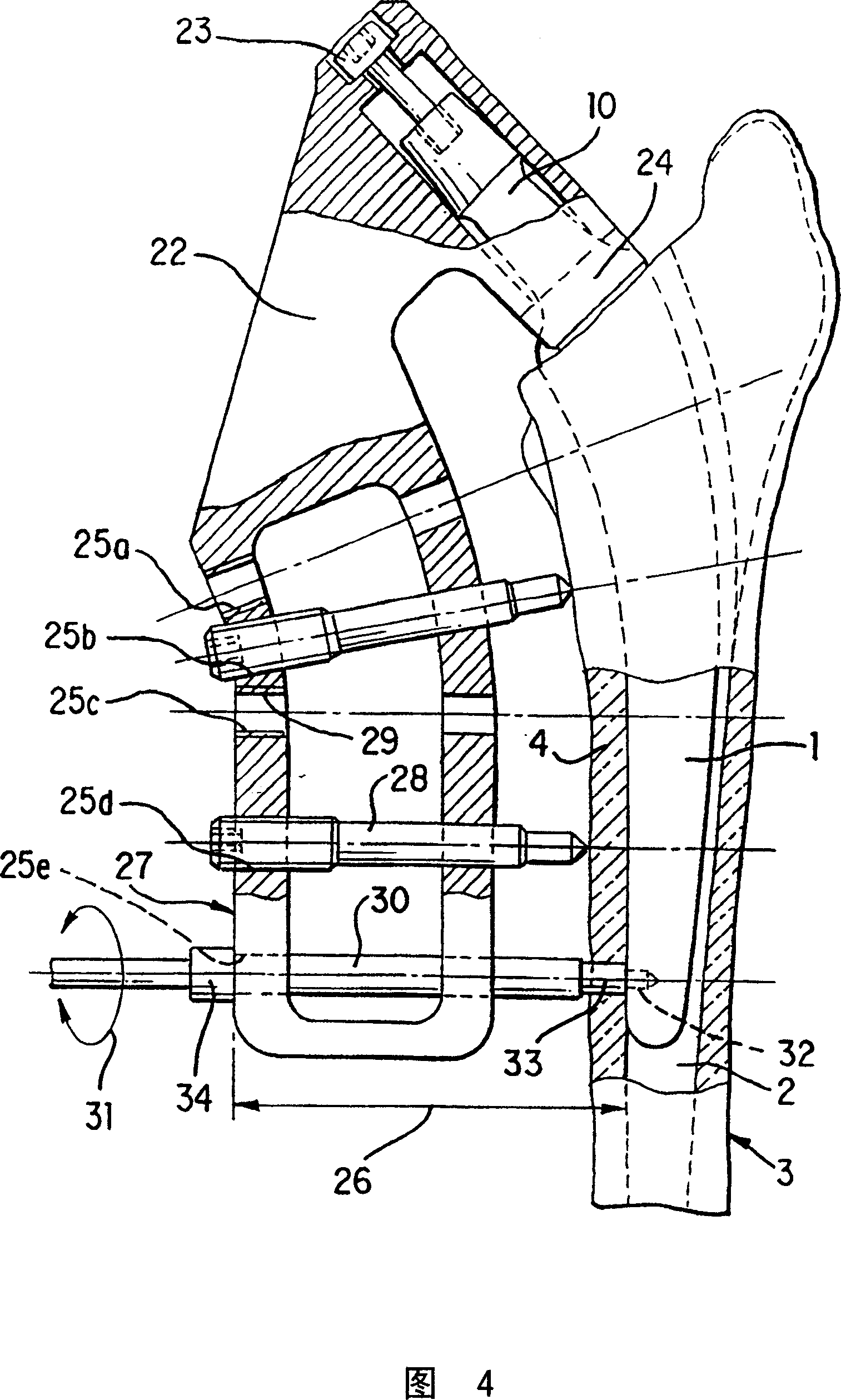 Screw anchored joint prosthesis