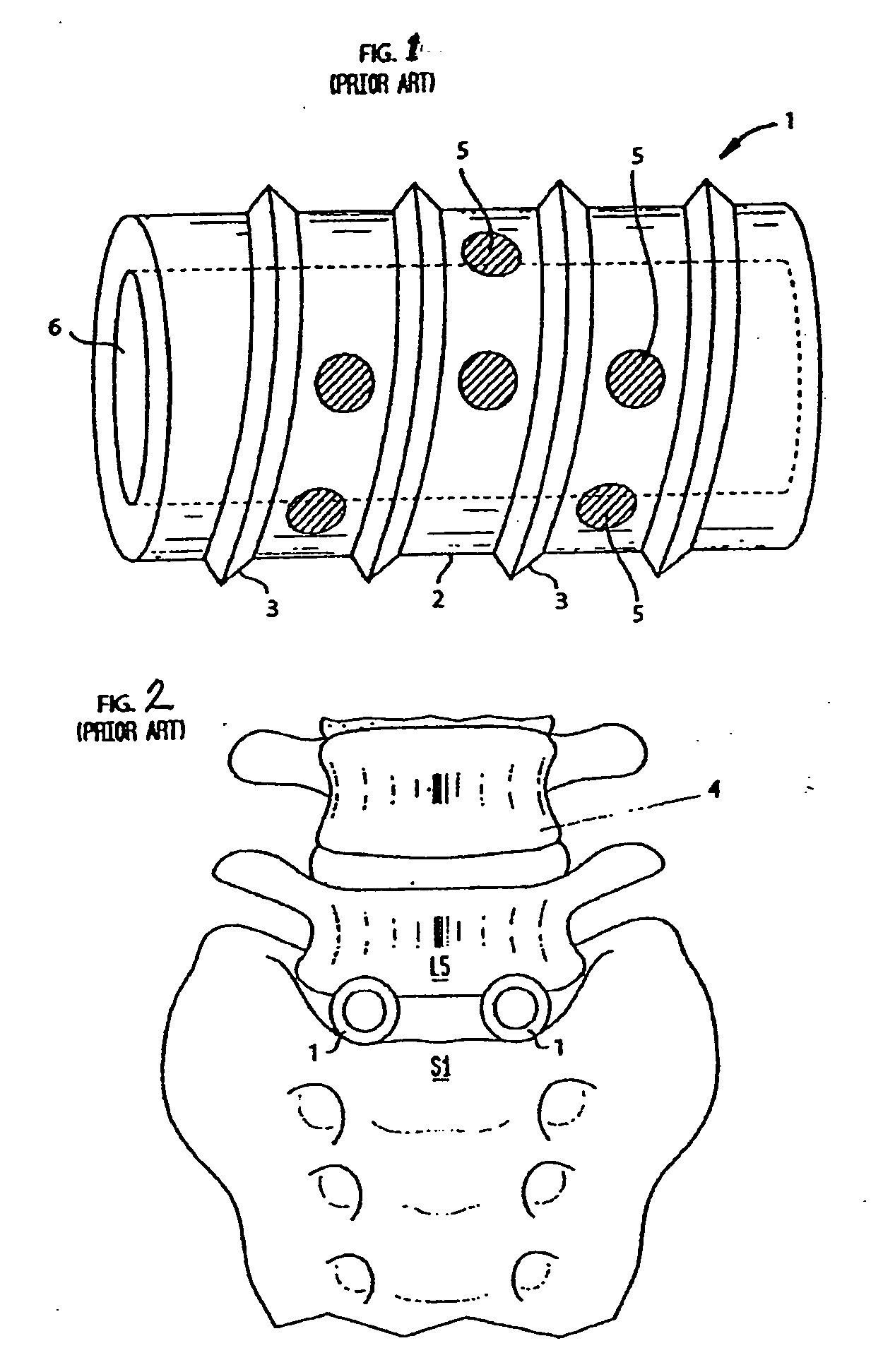 Artificial intervertebral disc having an articulating joint