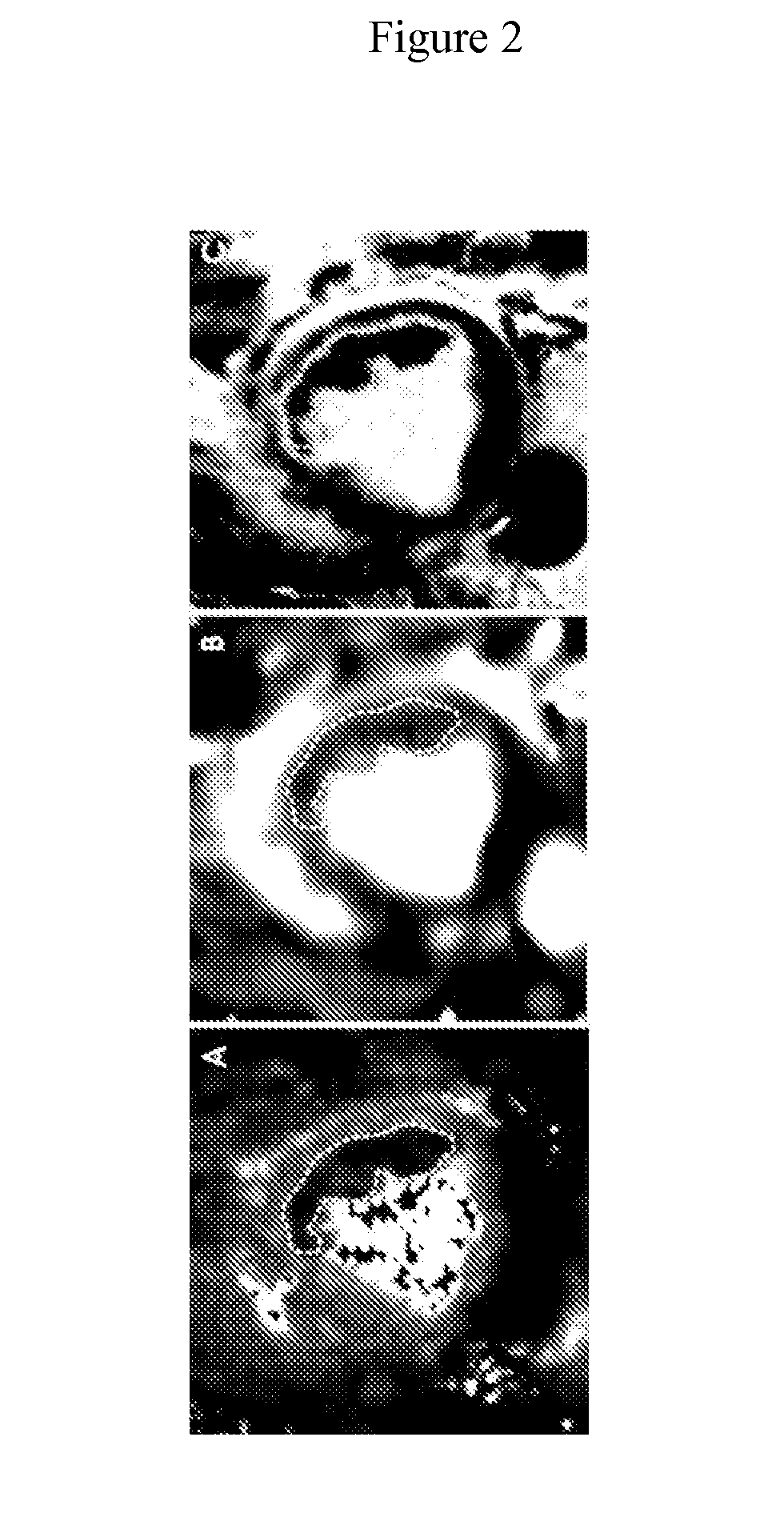 Assessment of iron deposition post myocardial infarction as a marker of myocardial hemorrhage