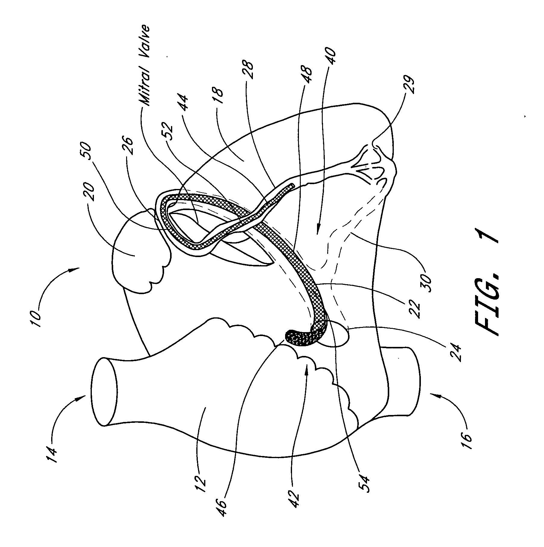 Heart valve leaflet locator