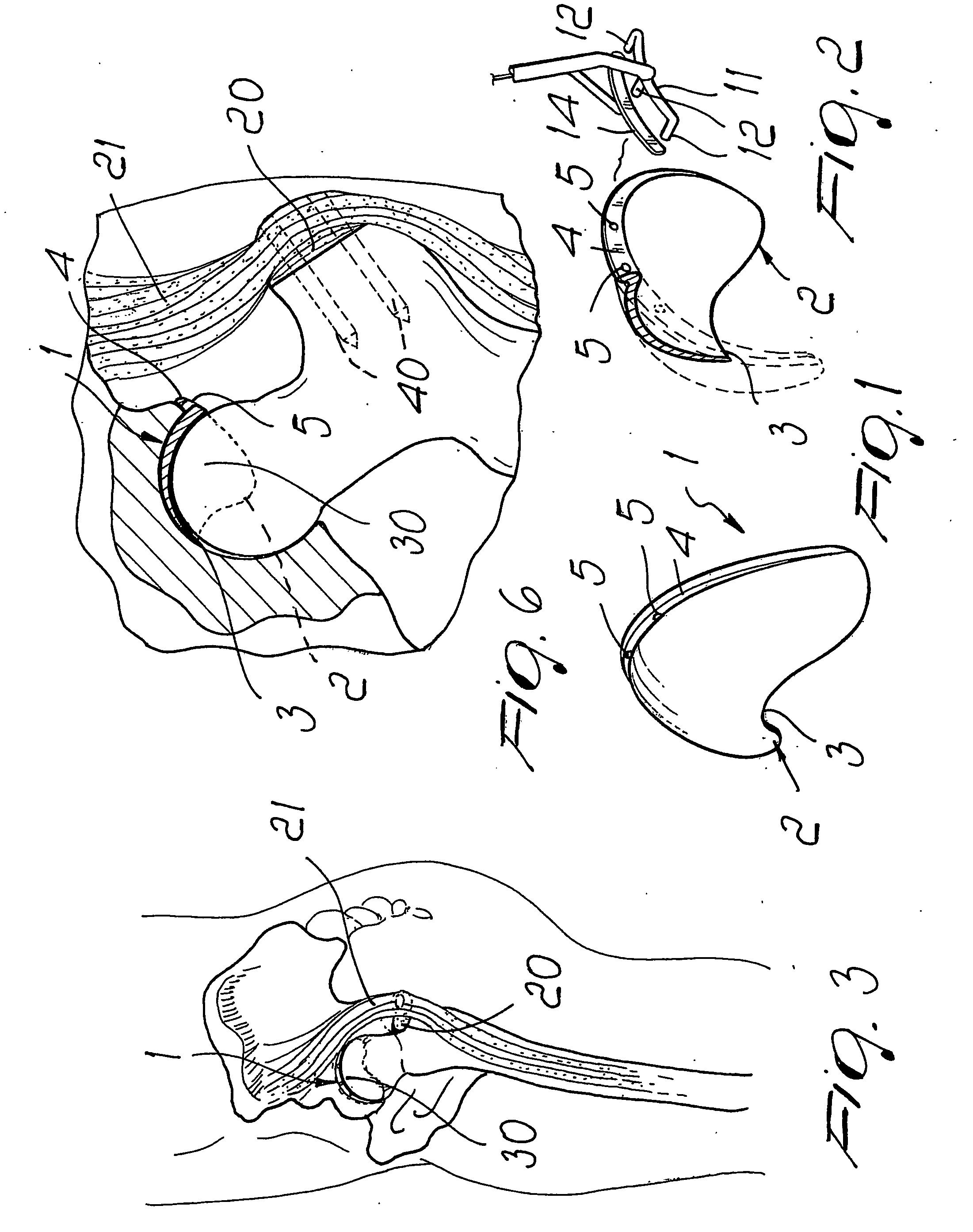 Corrective element for the articulation between the femur and the pelvis