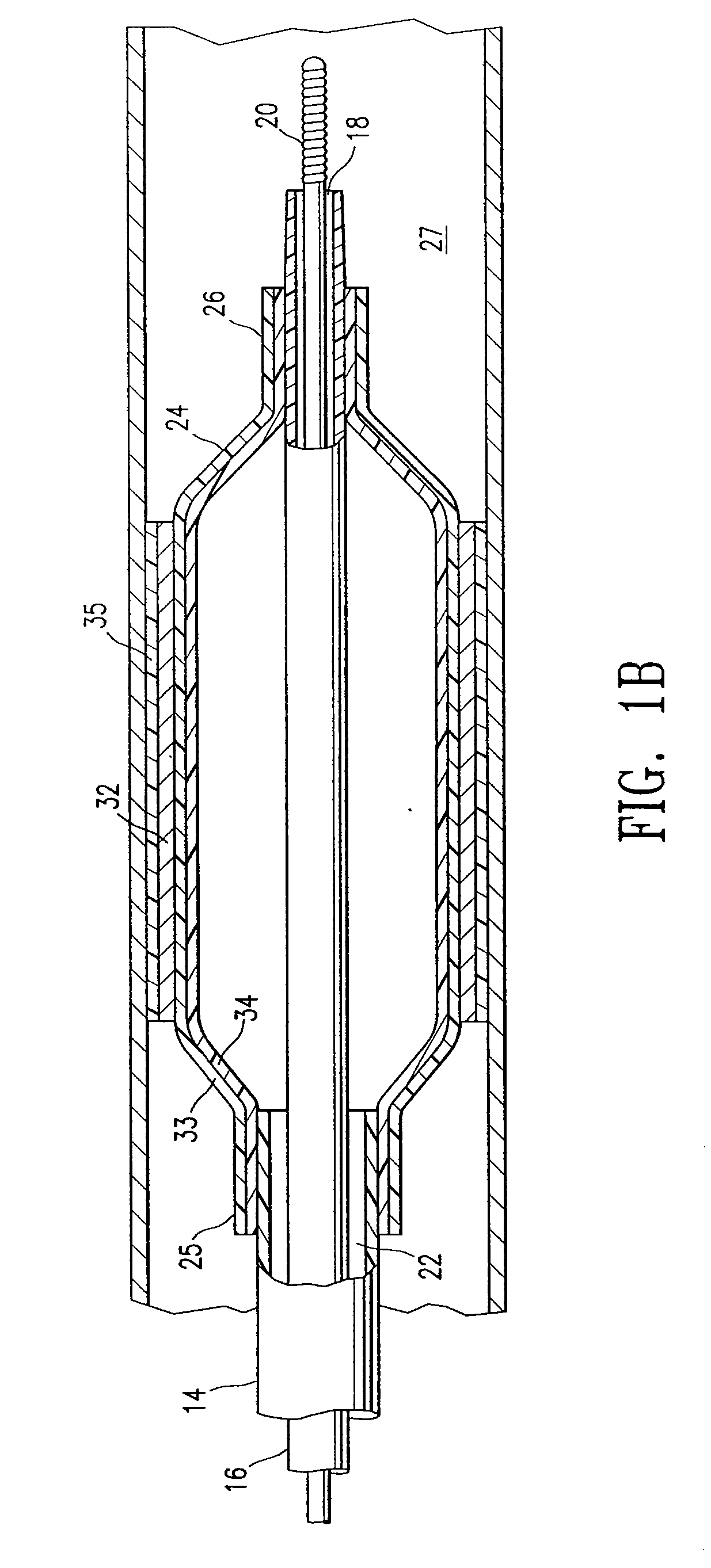 Catheter balloon