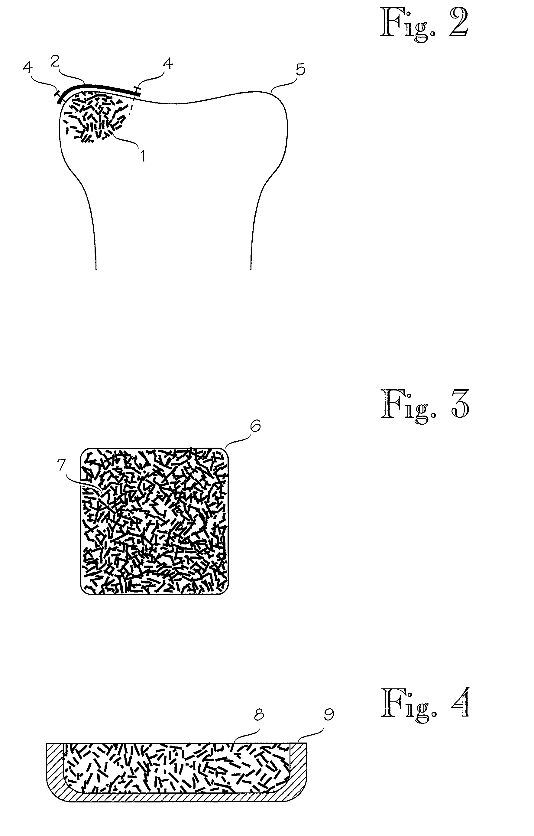 Bone grafting materials