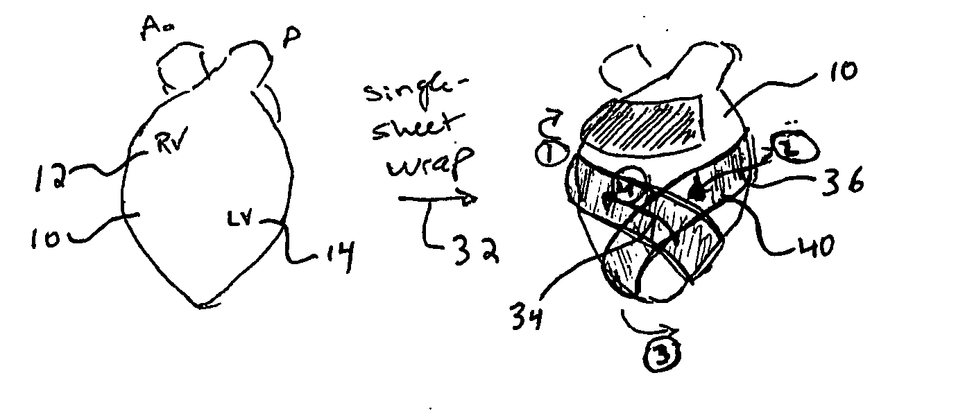 Micro electromechanical machine-based ventricular assist apparatus