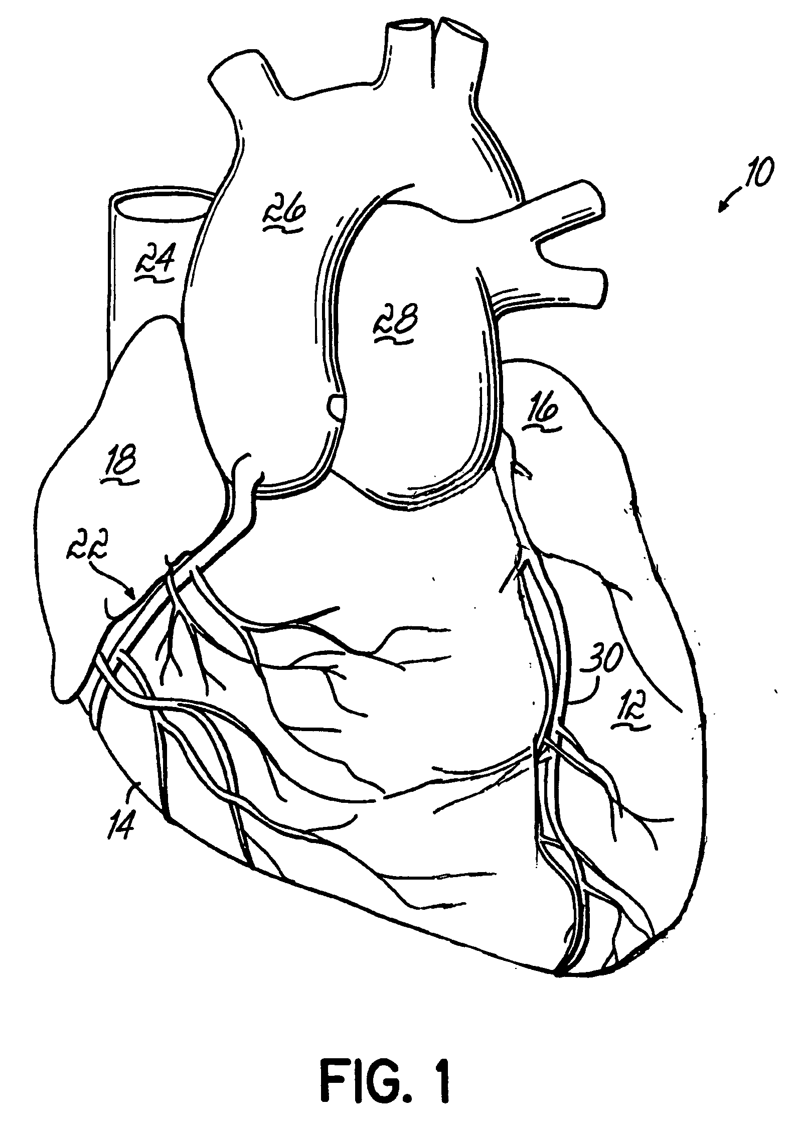 Micro electromechanical machine-based ventricular assist apparatus