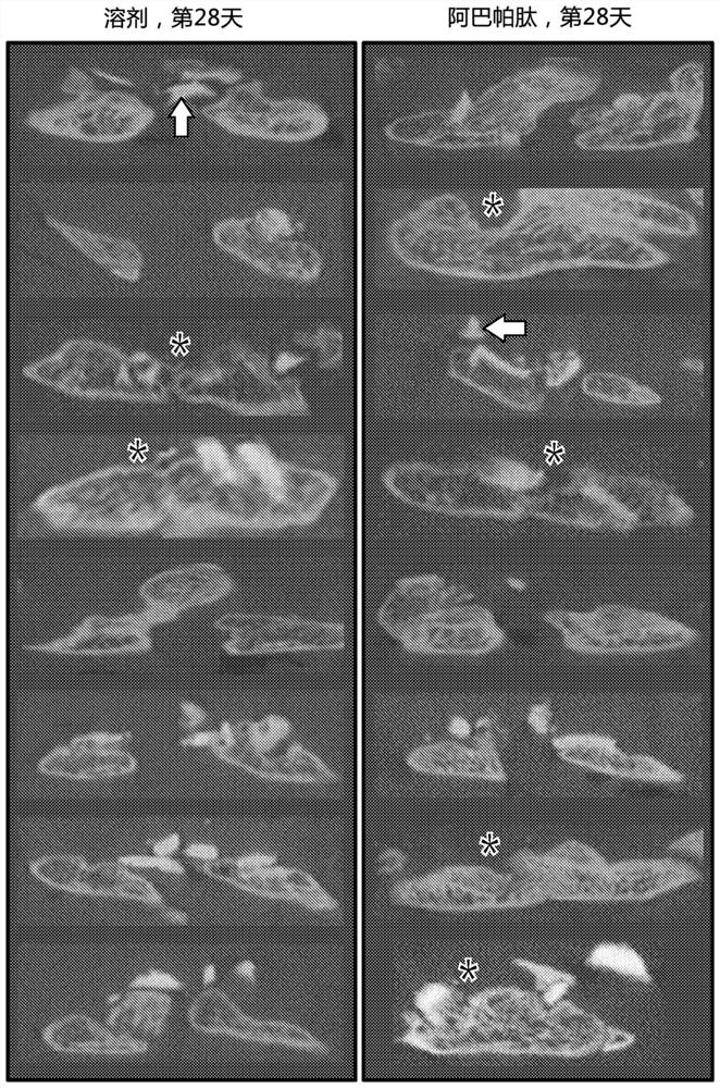 Methods of improving spinal fusion with abavatide