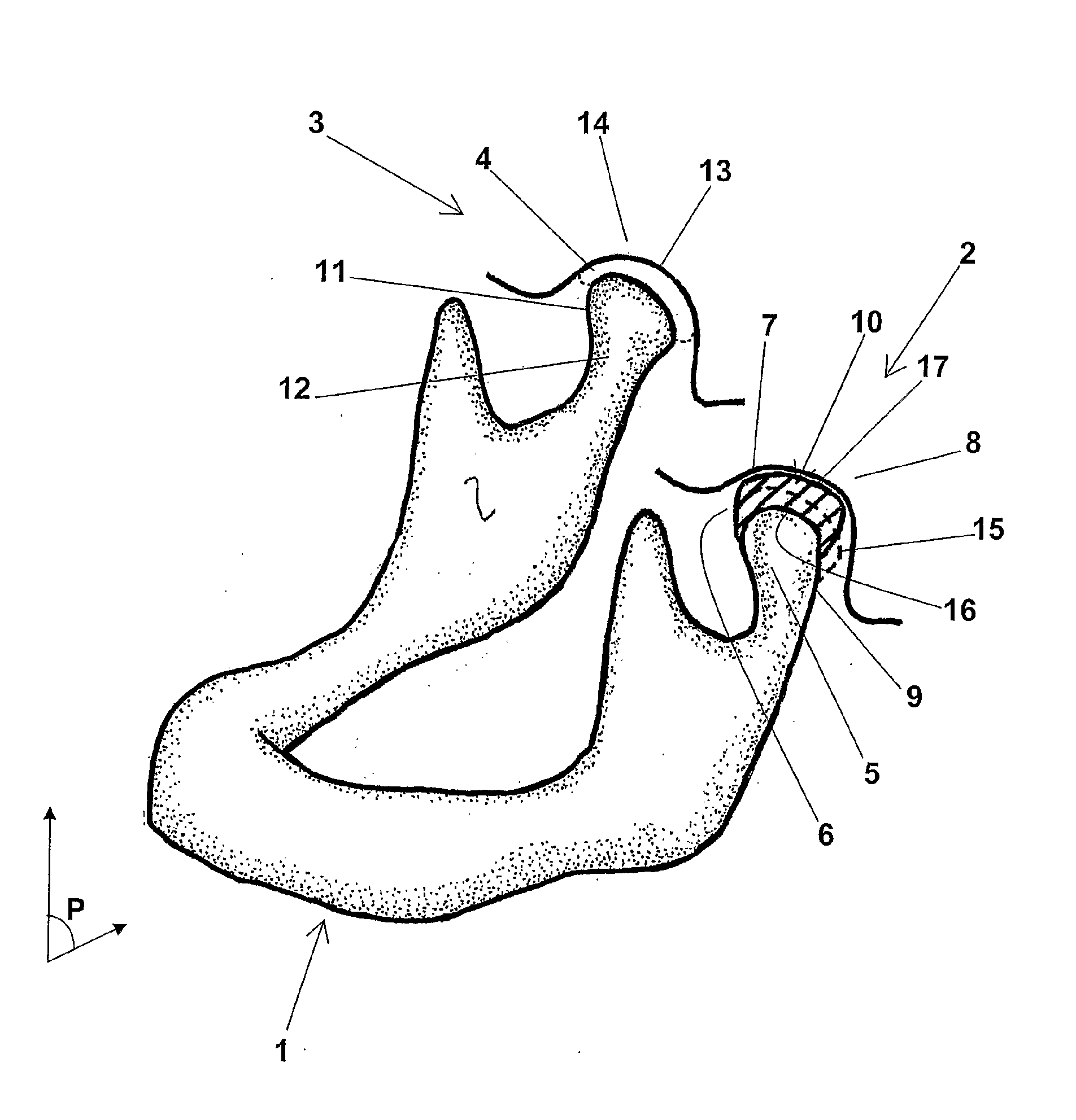 Temporomandibular prosthetic implant, and corresponding production method