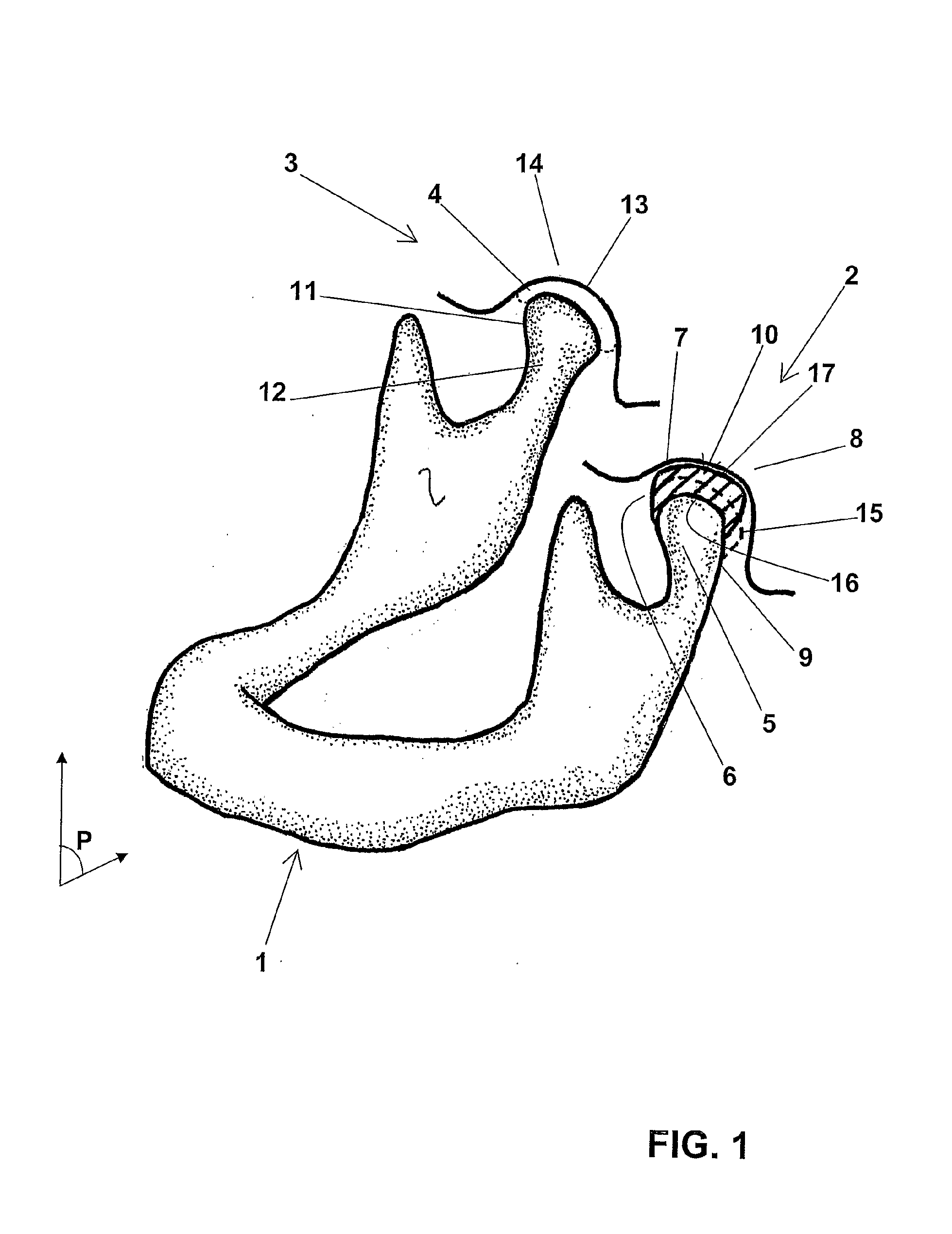 Temporomandibular prosthetic implant, and corresponding production method