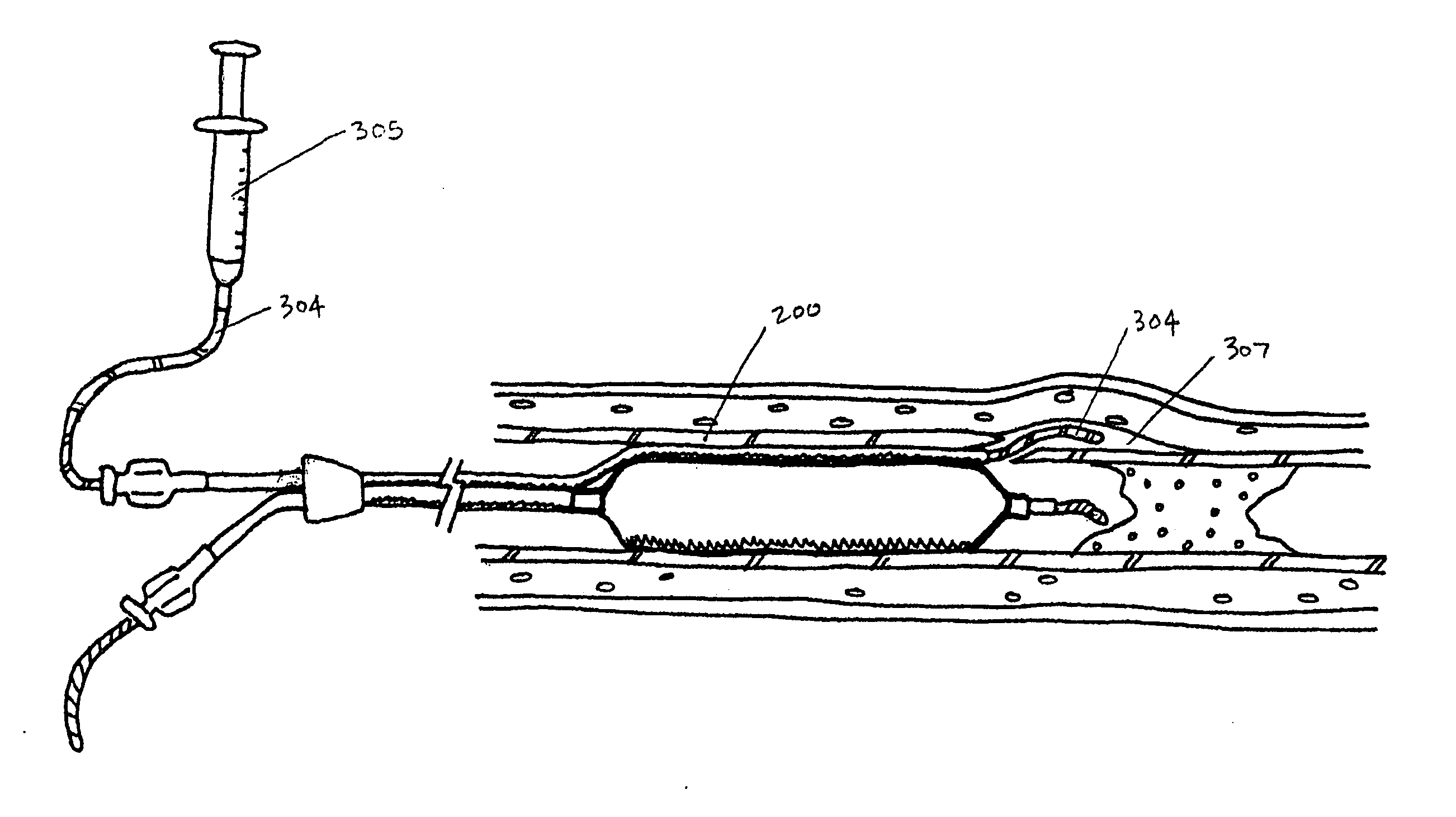 Endovascular devices and methods