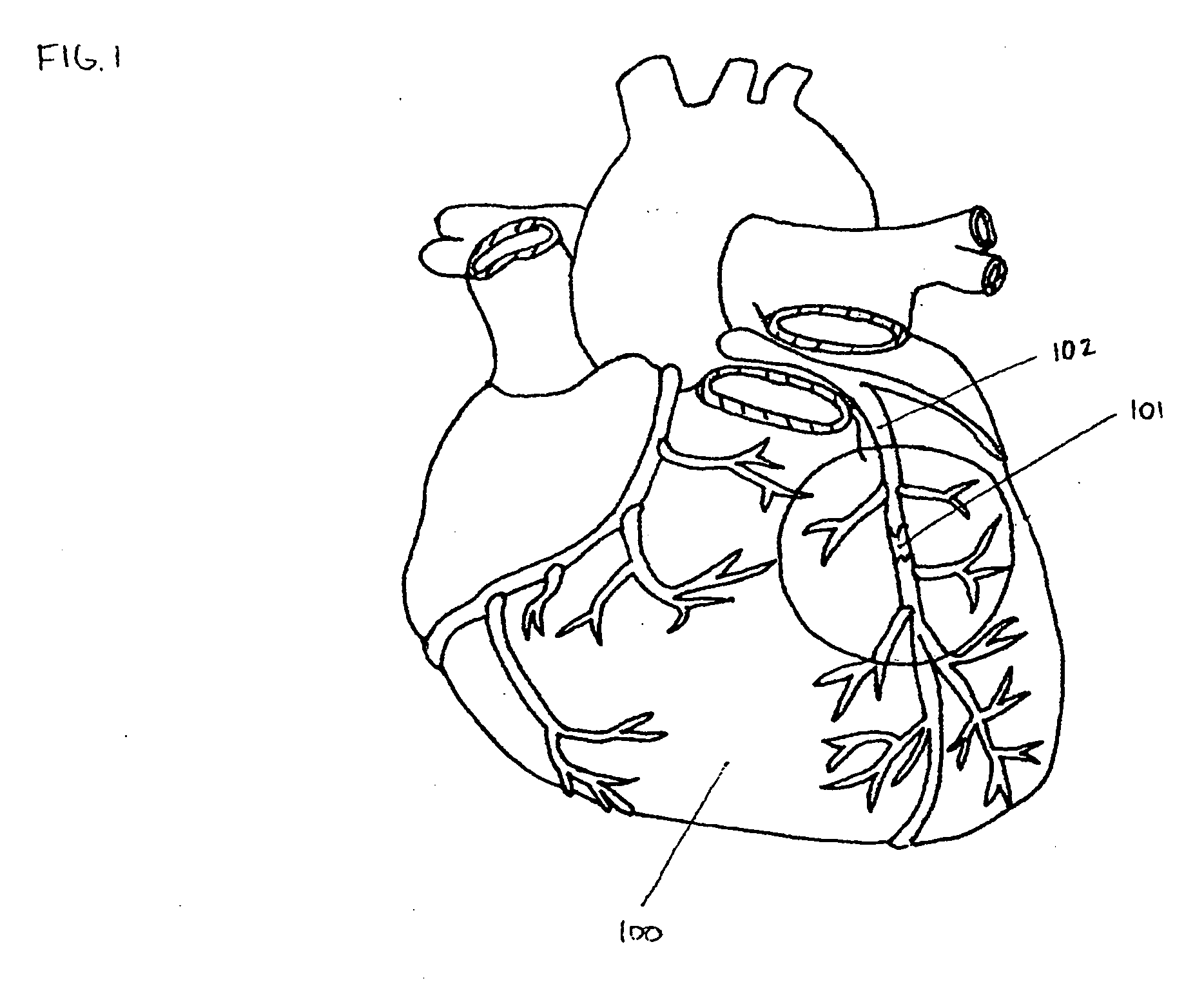 Endovascular devices and methods