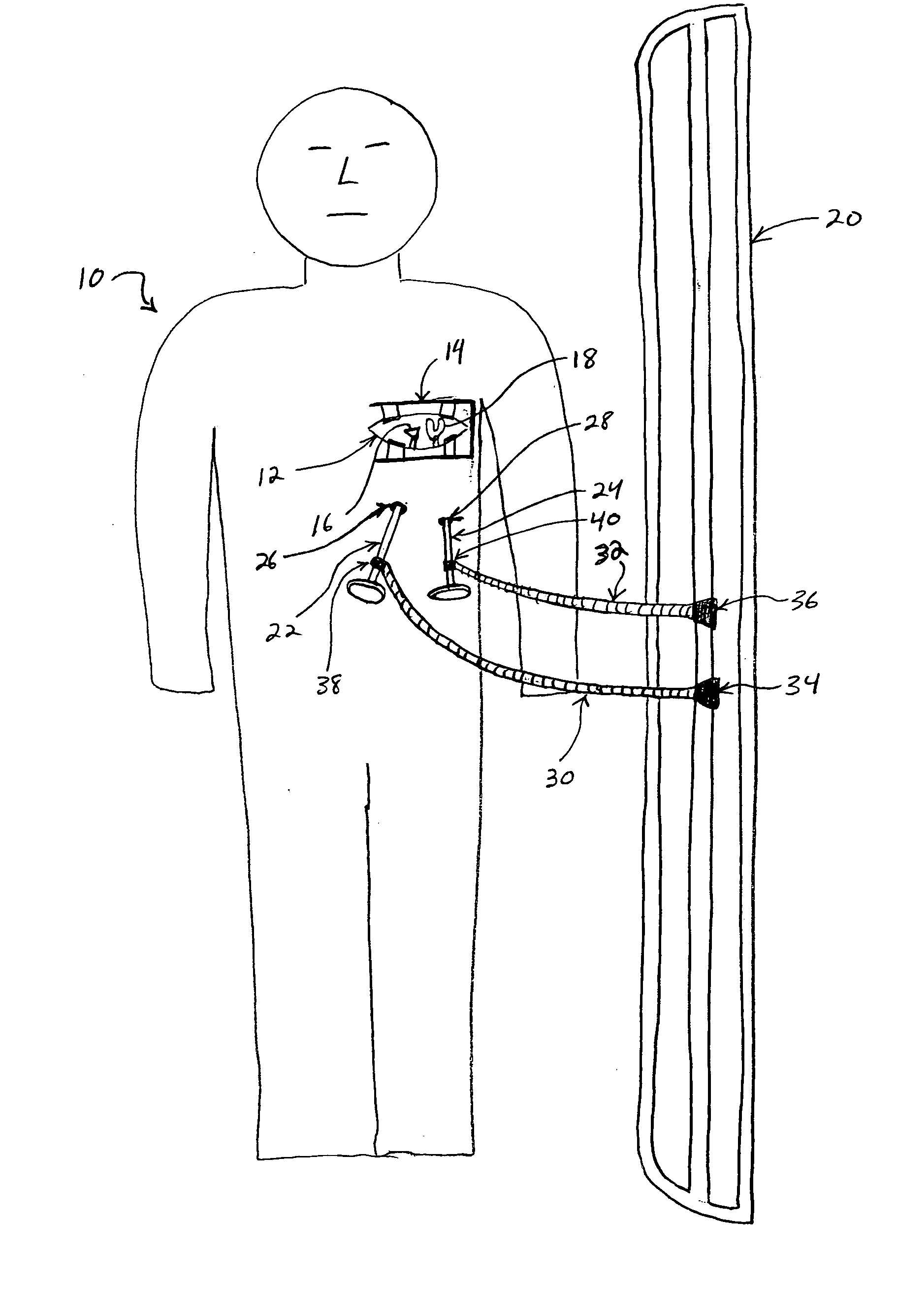 Methods and devices for cardiac surgery