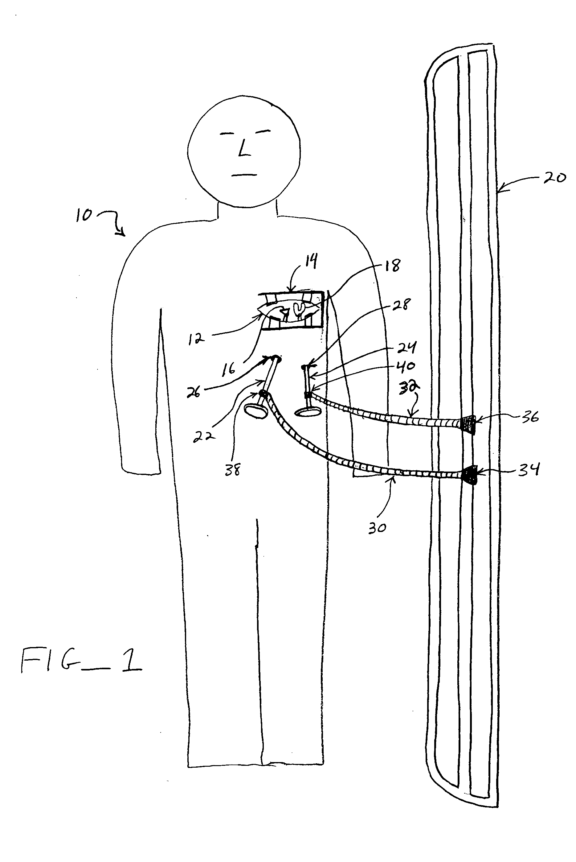 Methods and devices for cardiac surgery