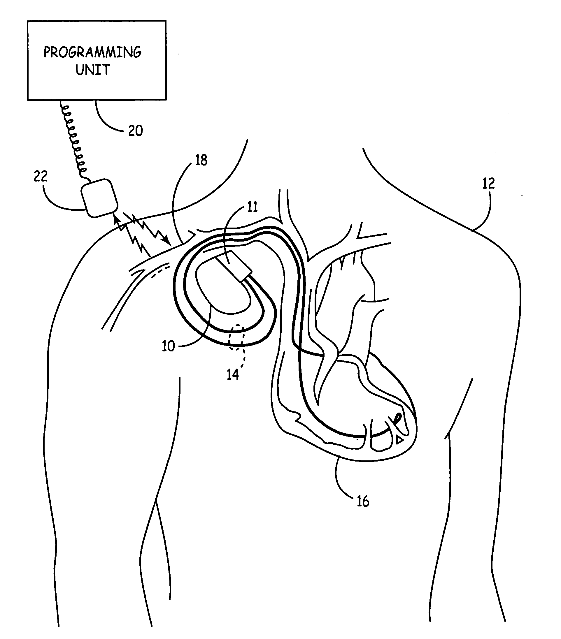 Personalization software for implanted medical device patients