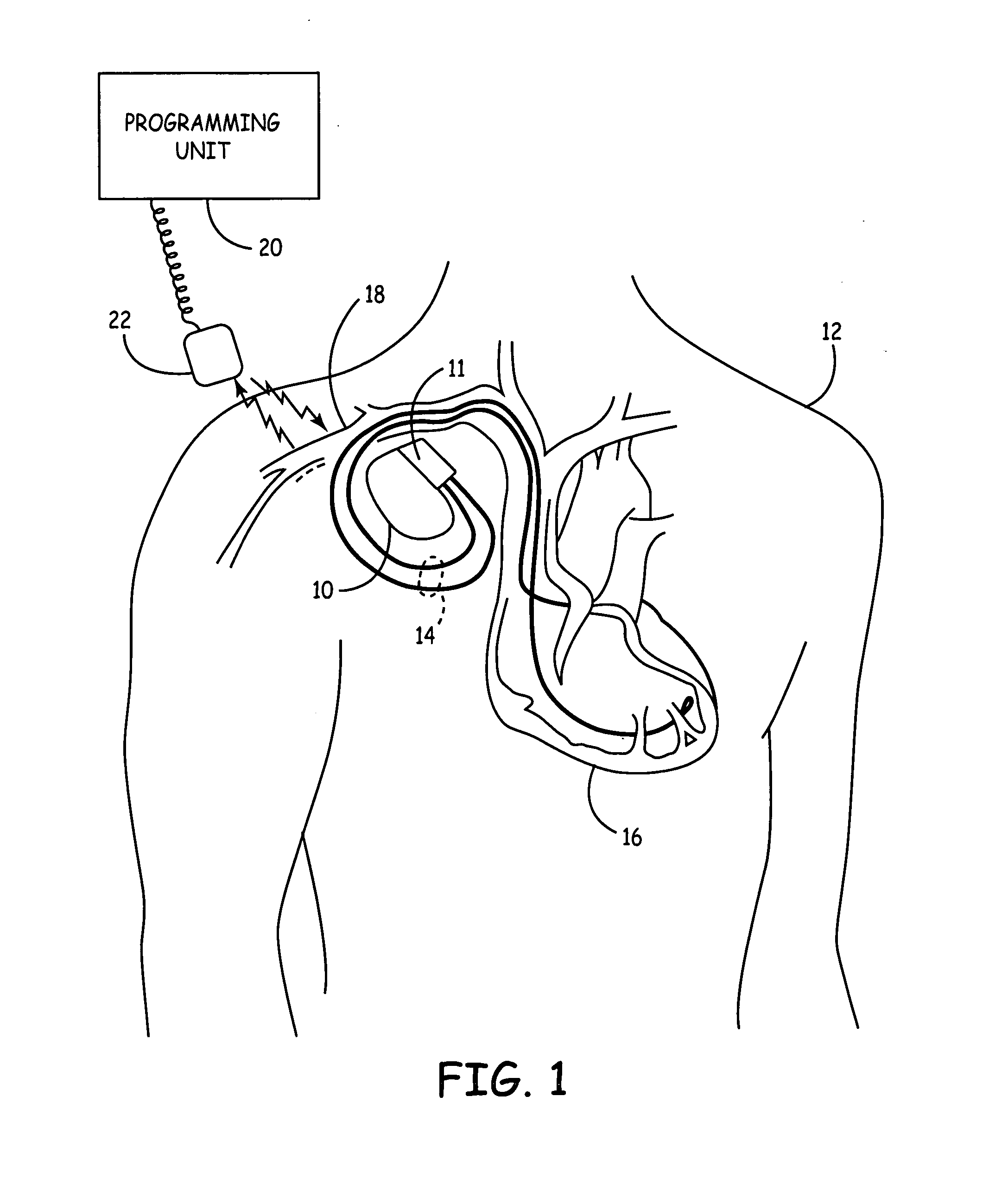 Personalization software for implanted medical device patients