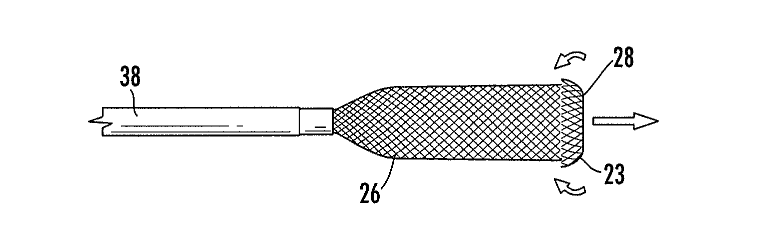 Stent graft for reinforcement of vascular abnormalities and associated method