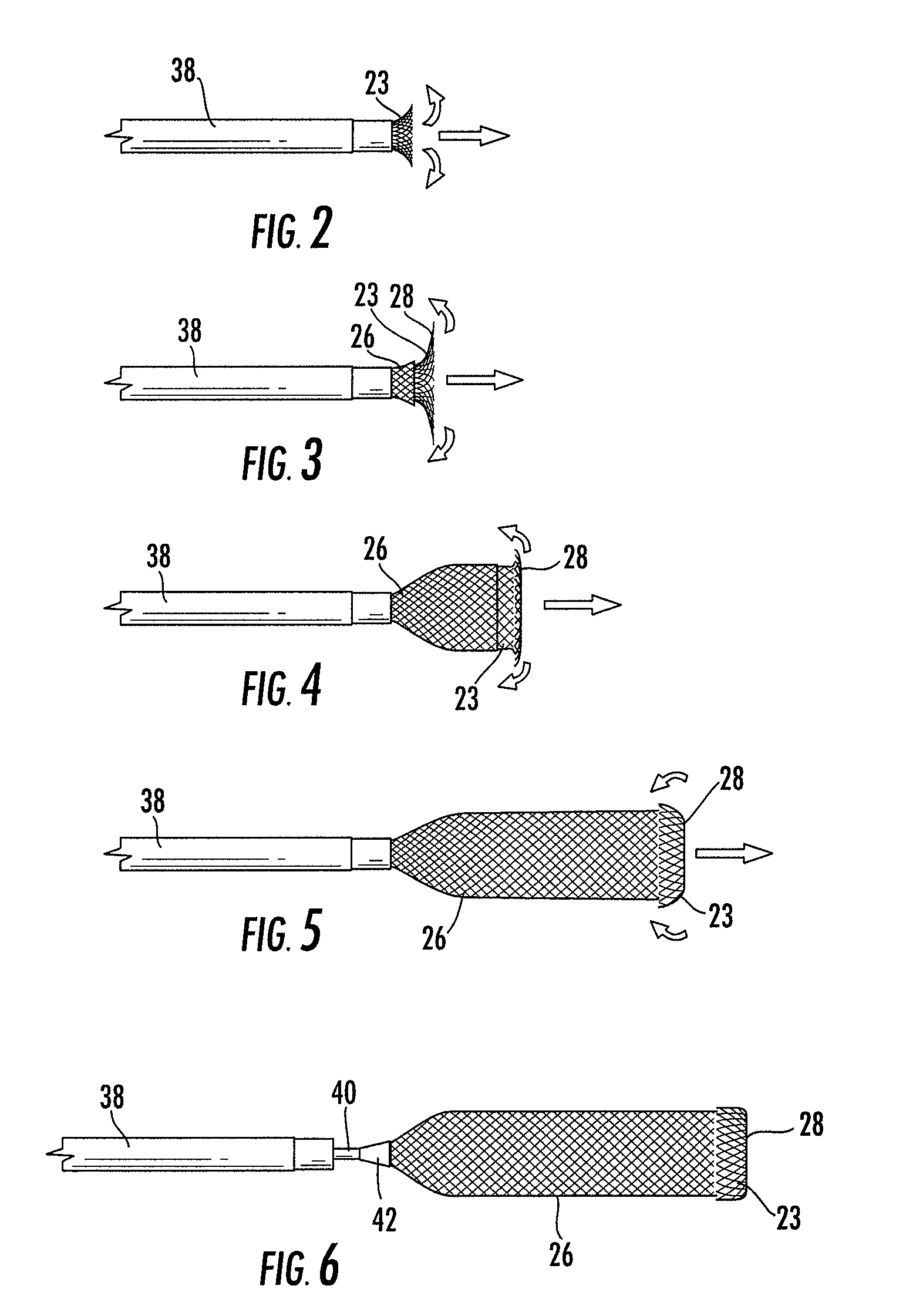 Stent graft for reinforcement of vascular abnormalities and associated method