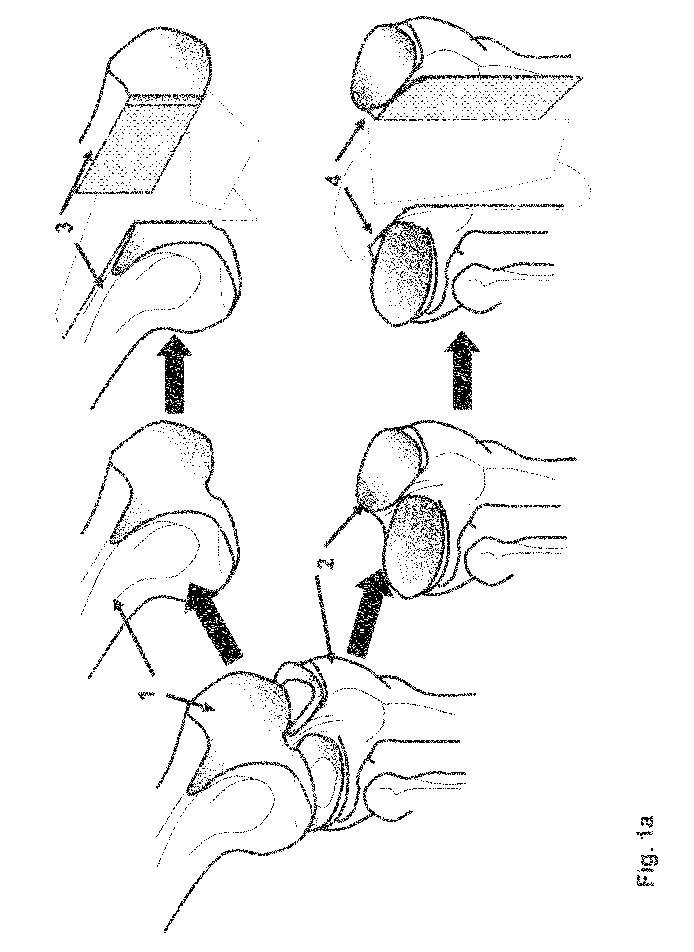 Devitalization and recellularization of cartilage