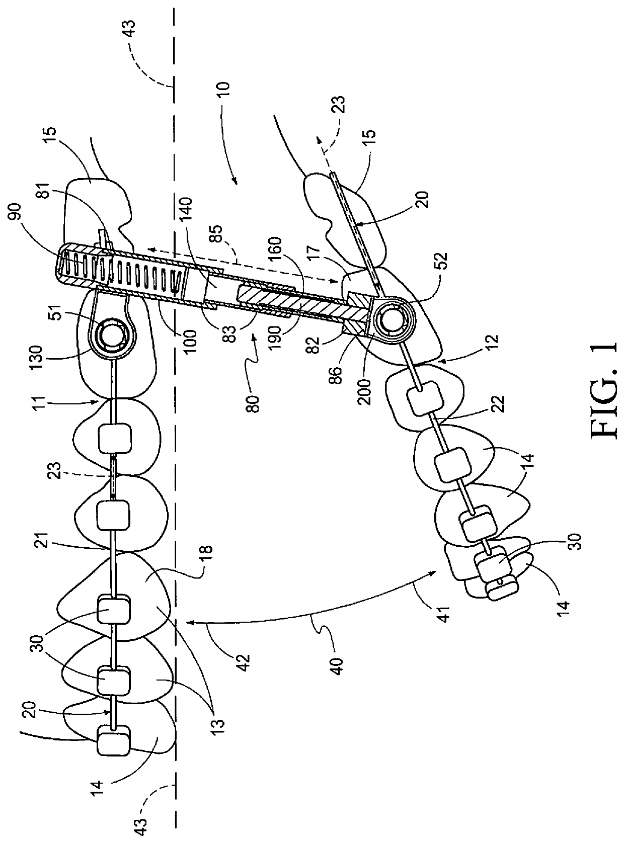 Method and Apparatus for Treating Malocclusions and Teeth Alignment