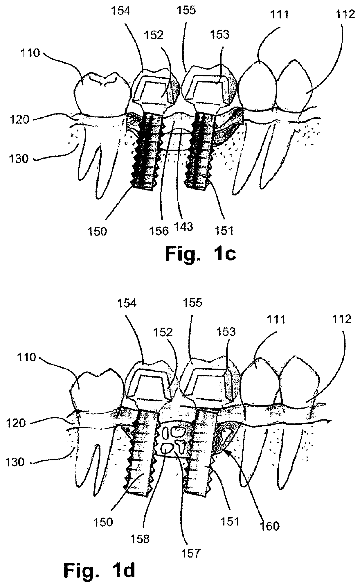 Computer implemented planning and providing of mass customized bone structure