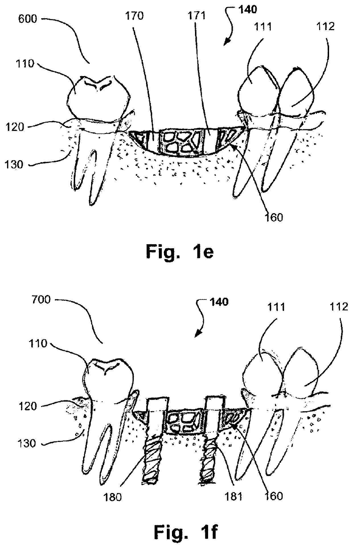 Computer implemented planning and providing of mass customized bone structure