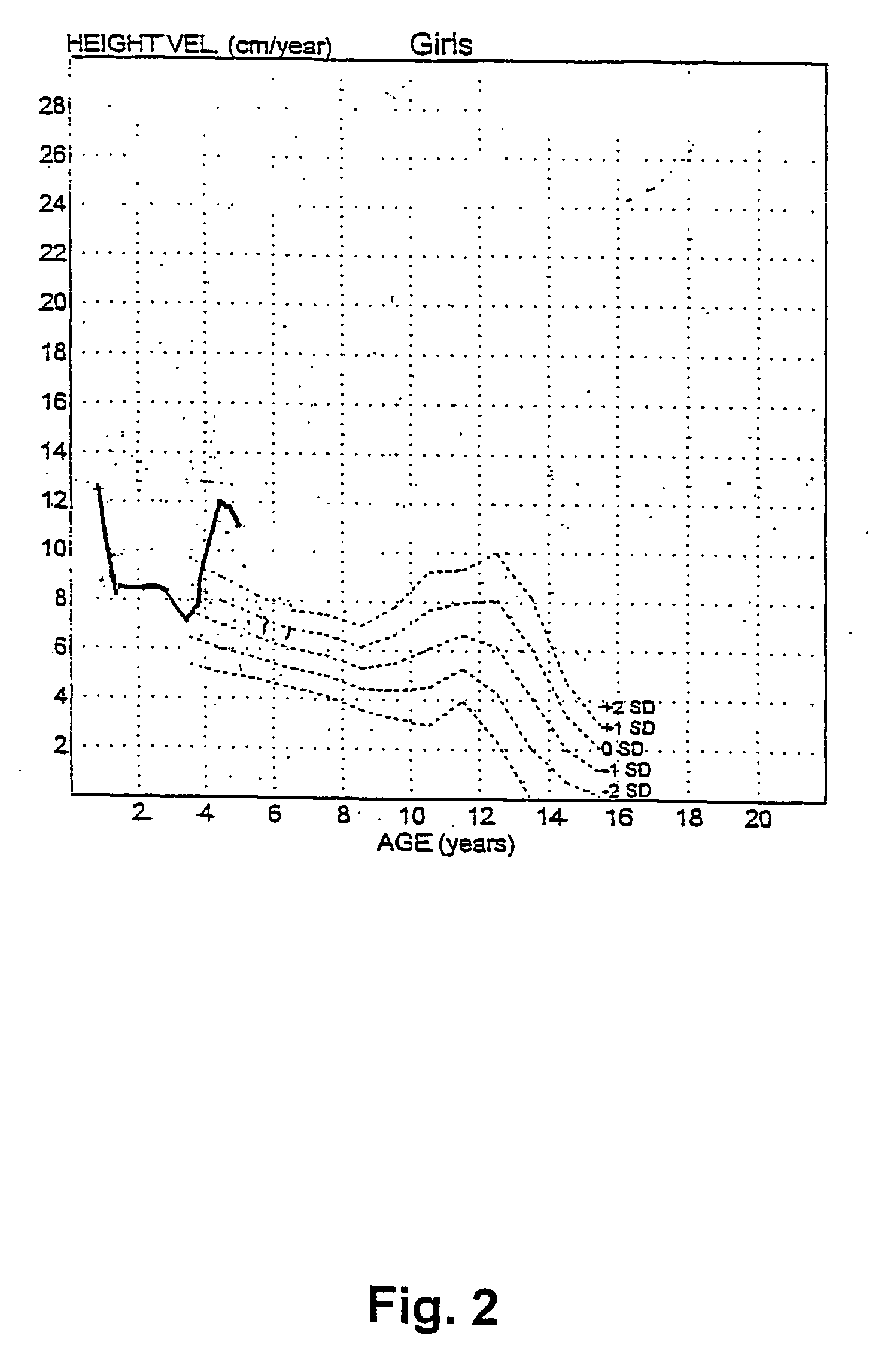 Human growth hormone for treating children with abnormal short stature and kits and methods for diagnosing gs protein dysfunctions