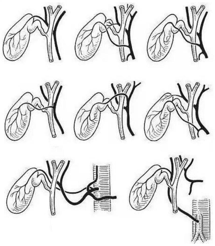 Laparoscopic cholecystectomy training device and method based on 3D printing technology