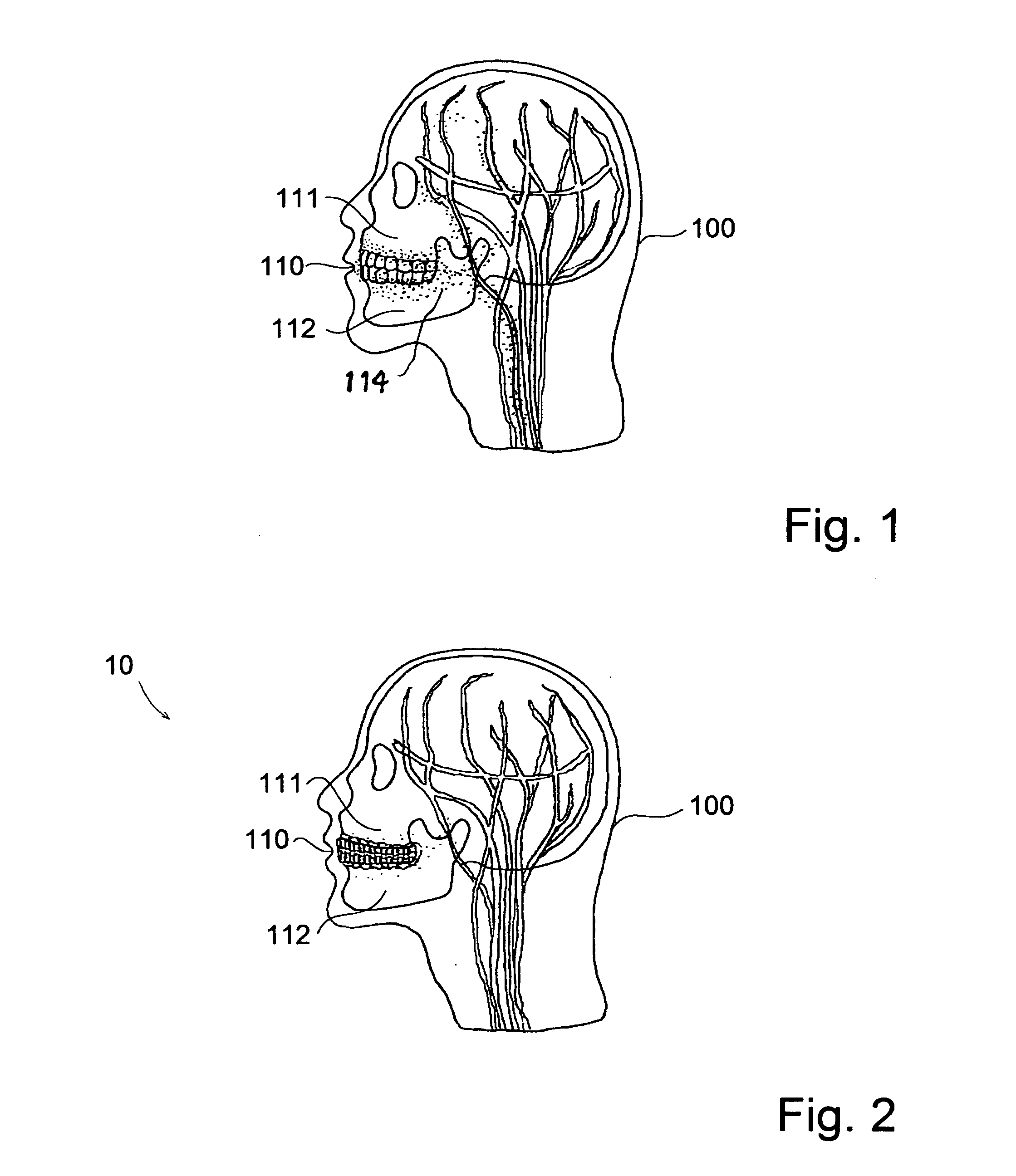 Aerobic mouthguard adapted to permit larger oral osmosis while diffusing larger oral shock