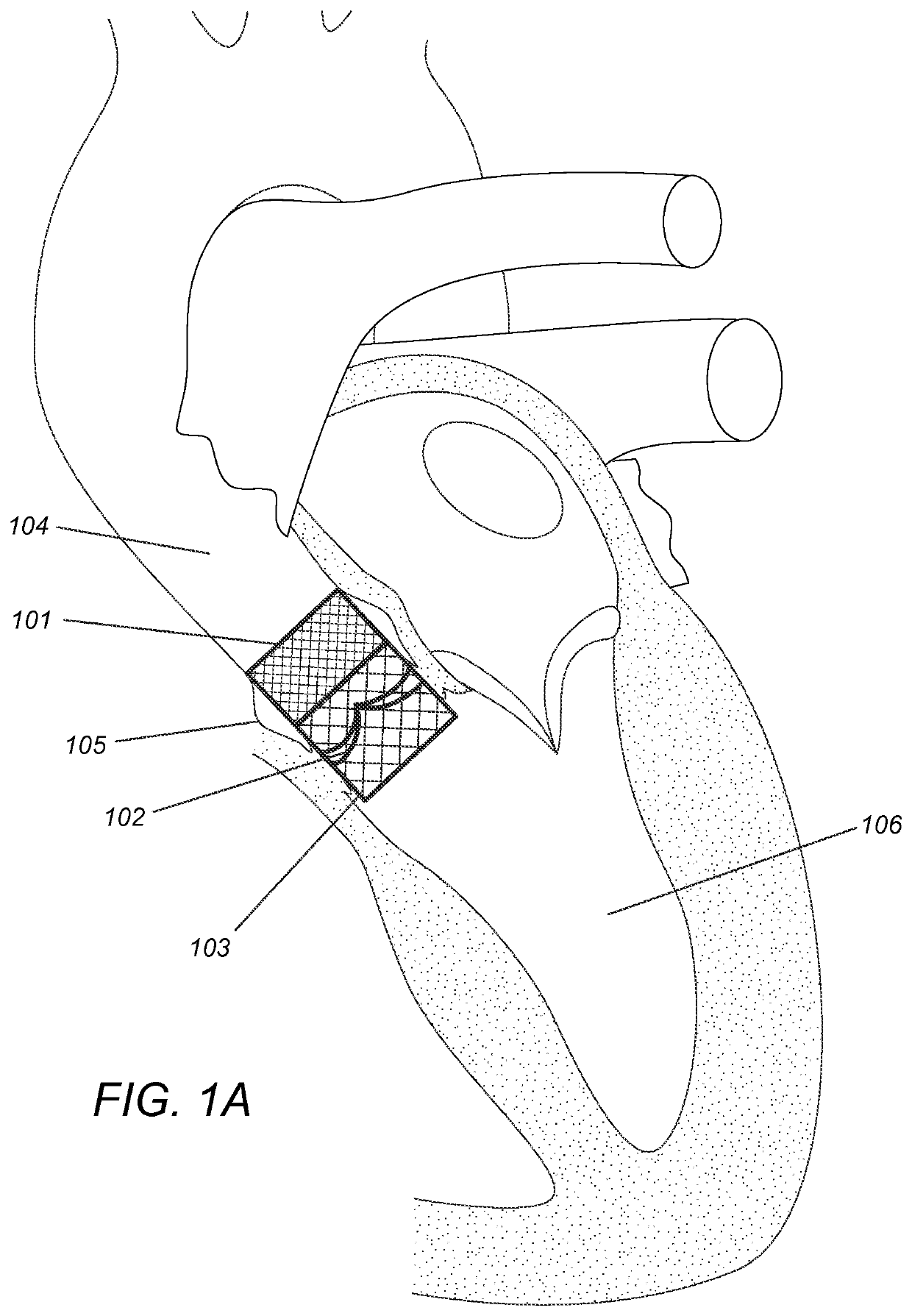 Modular dis-assembly of transcatheter valve replacement devices and uses thereof