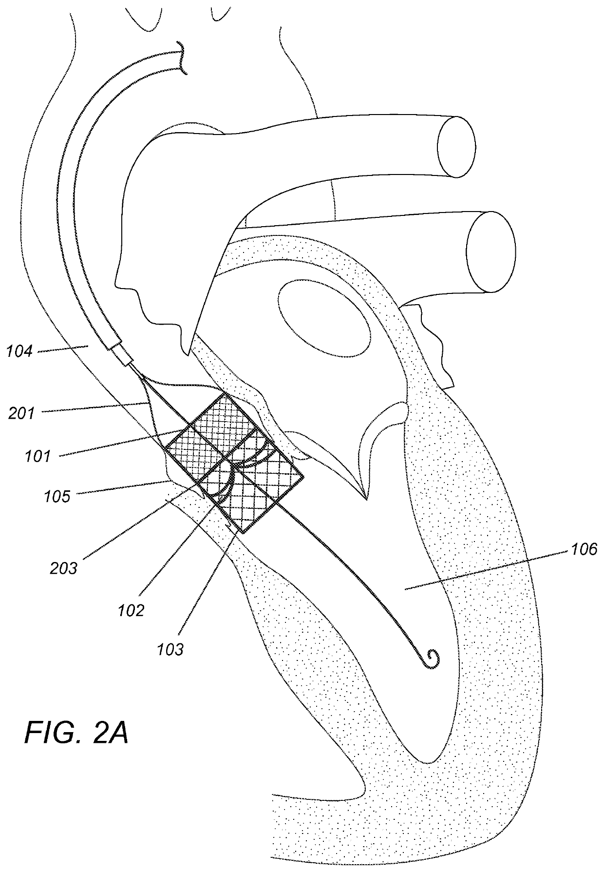 Modular dis-assembly of transcatheter valve replacement devices and uses thereof