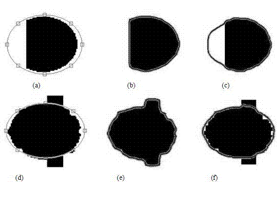 Method for segmenting uterine fibroid ultrasound image in HIFU treatment