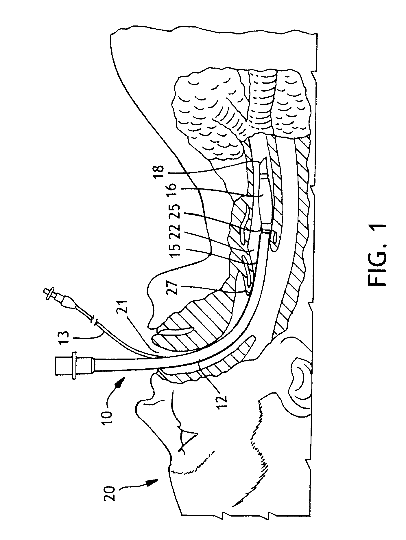 Low-pressure airway management device with active coating and method for patient care