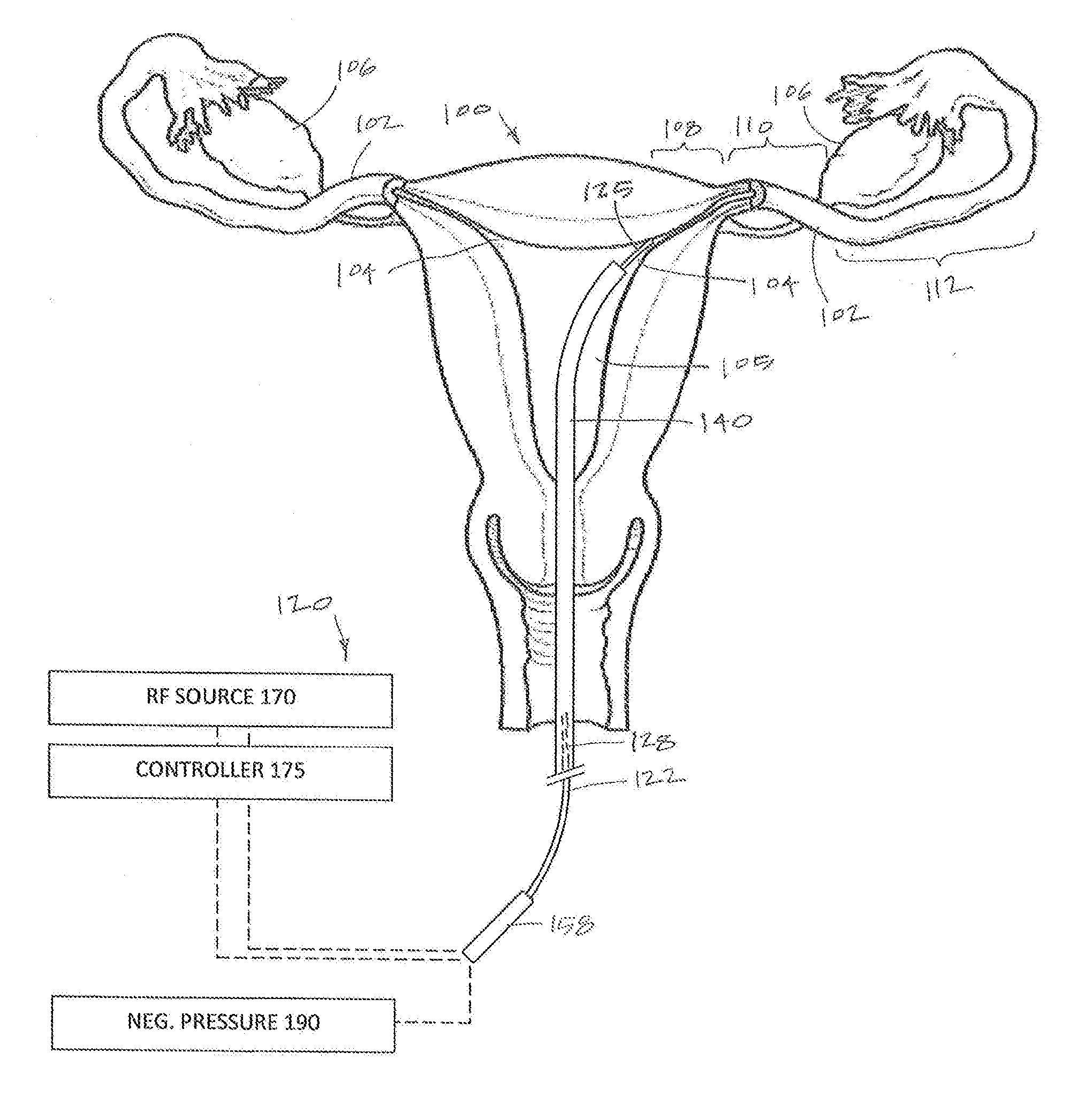 Systems and methods for permanent female contraception