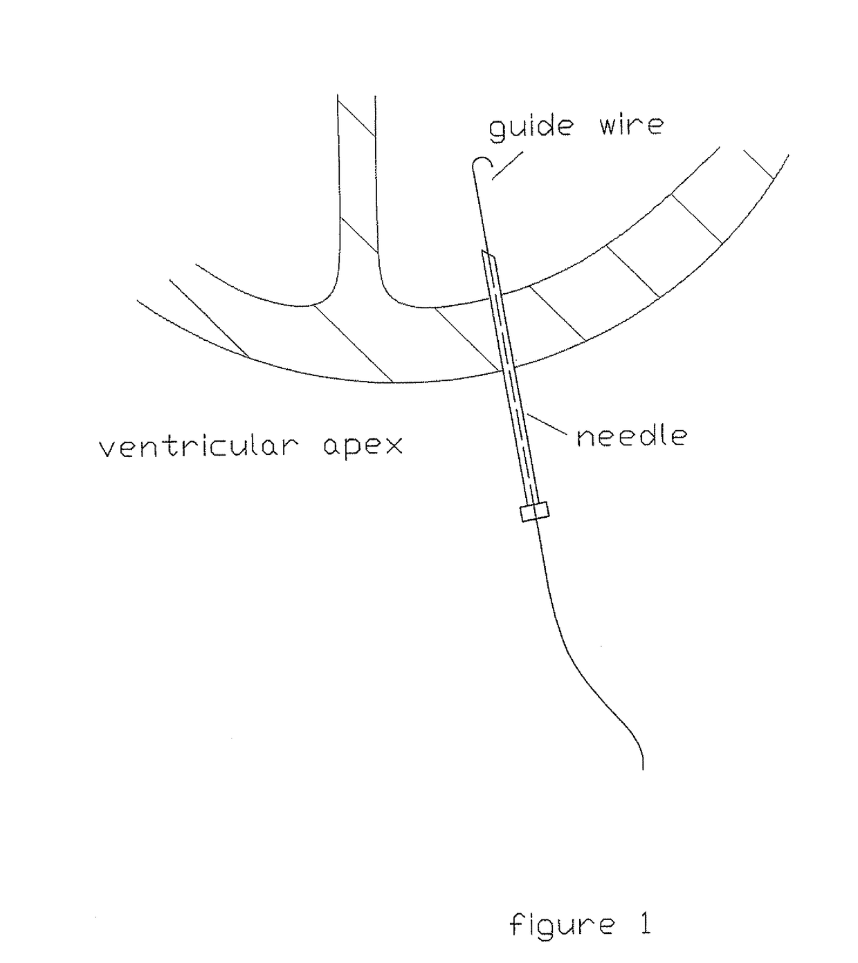 Cardiovascular procedures