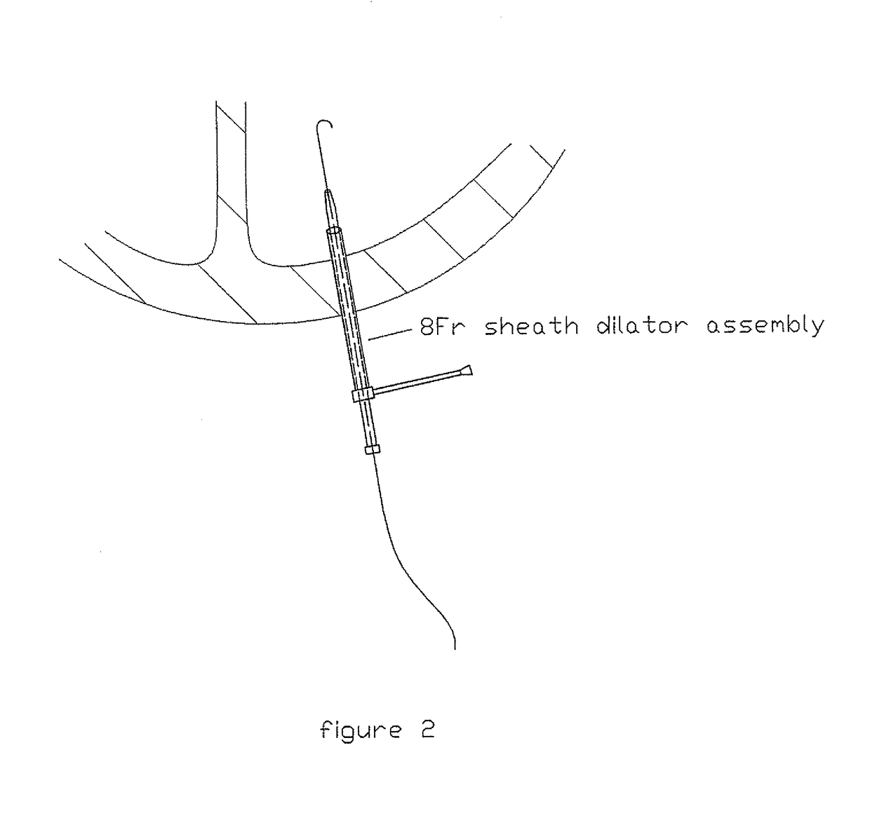 Cardiovascular procedures