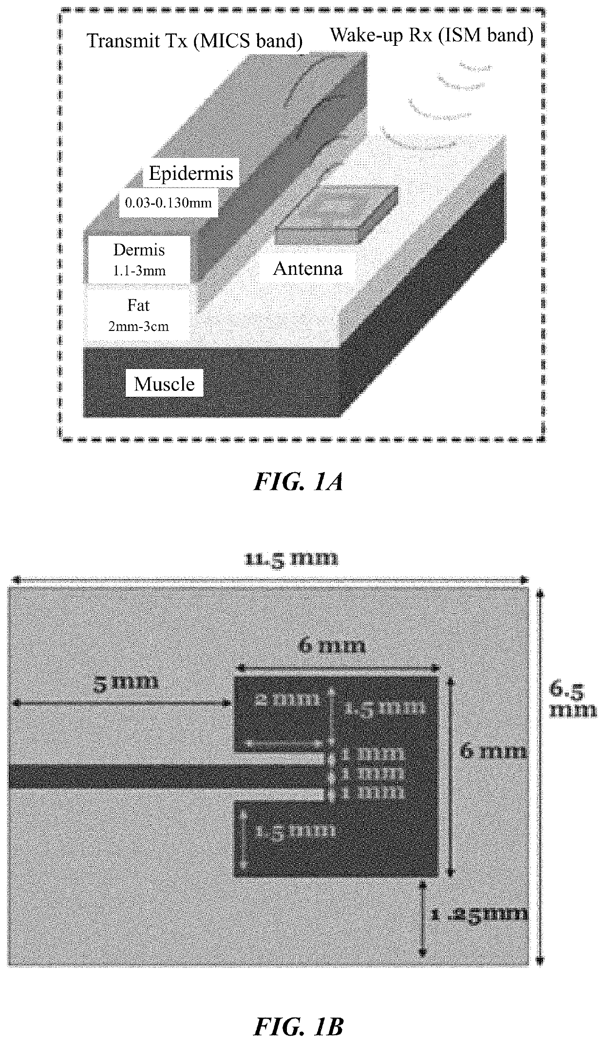 Continuous glucose monitoring based on remote sensing of variations of parameters of a SiC implanted antenna