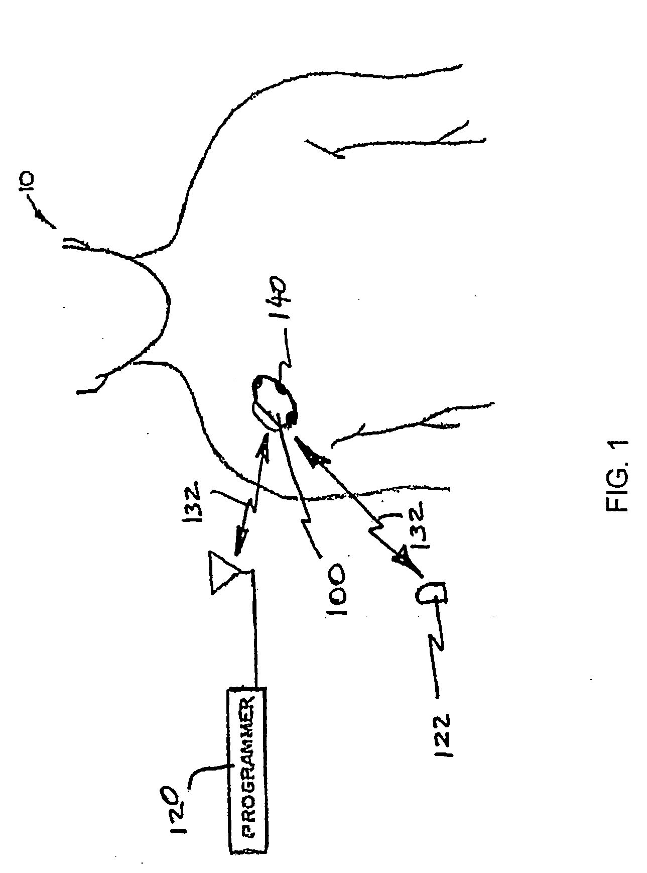 Techniques for user-activated data retention in an implantable medical device