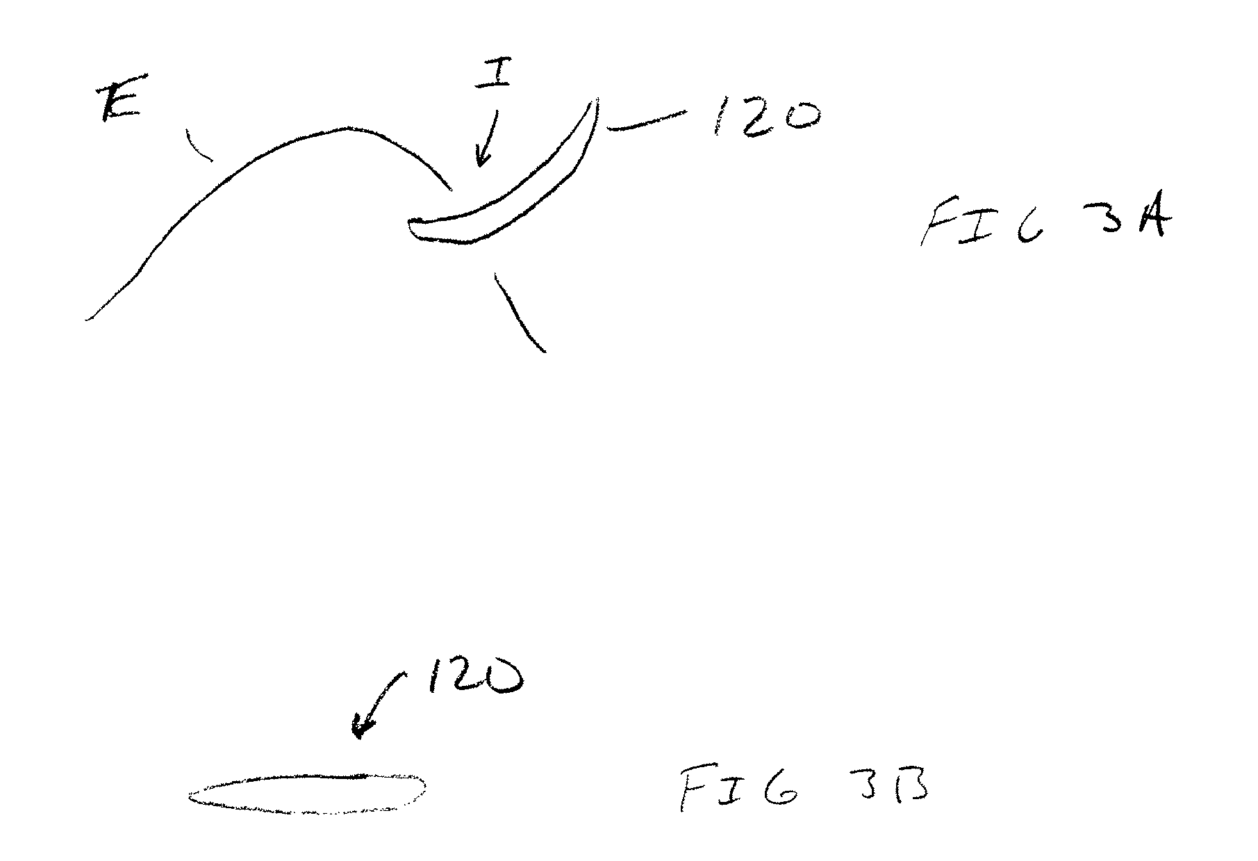 Capsulotomy device and method using electromagnetic induction heating