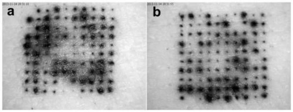 Salmon calcitonin soluble microneedle patch and preparation method thereof