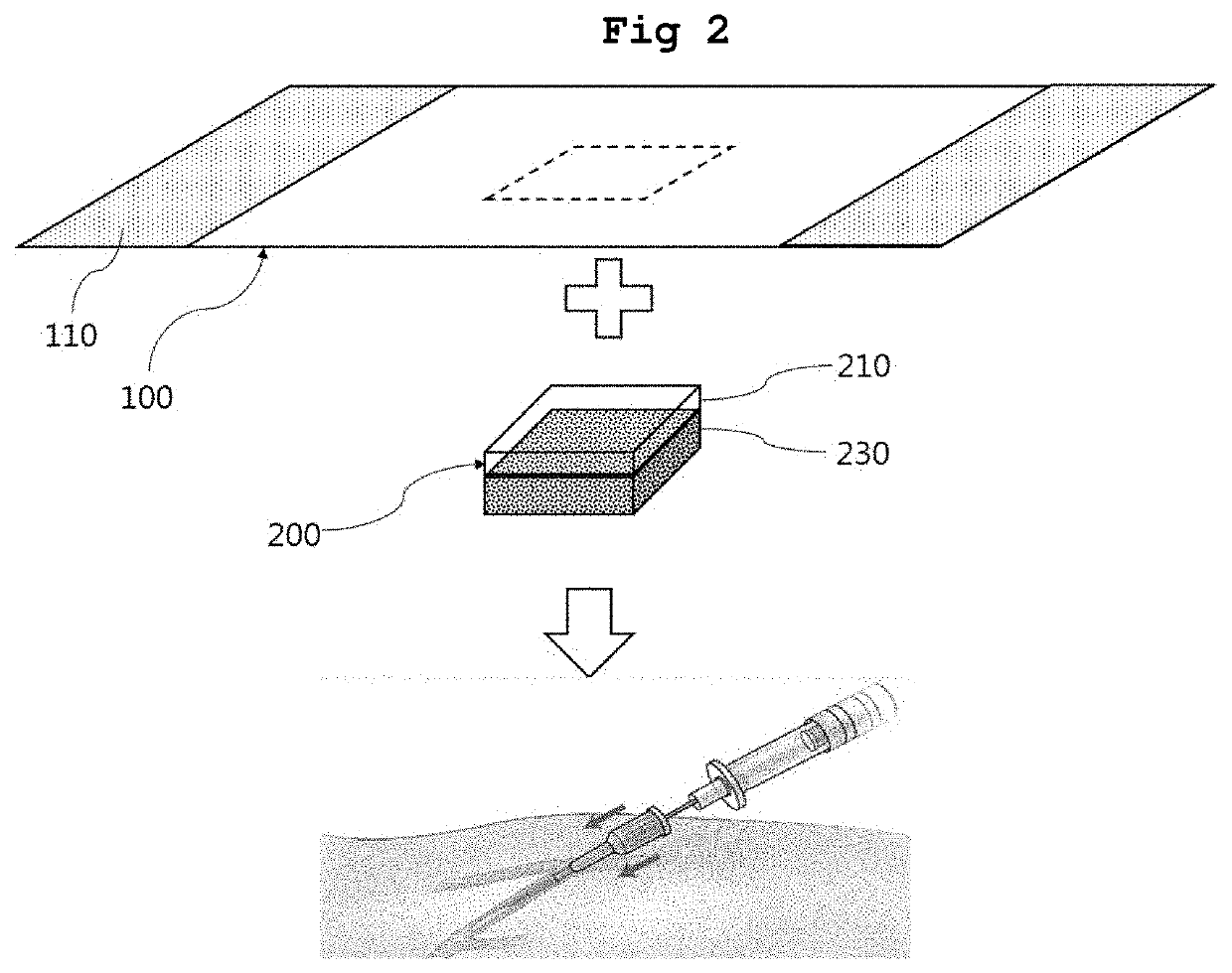 Expandable compression bandage for hemostasis