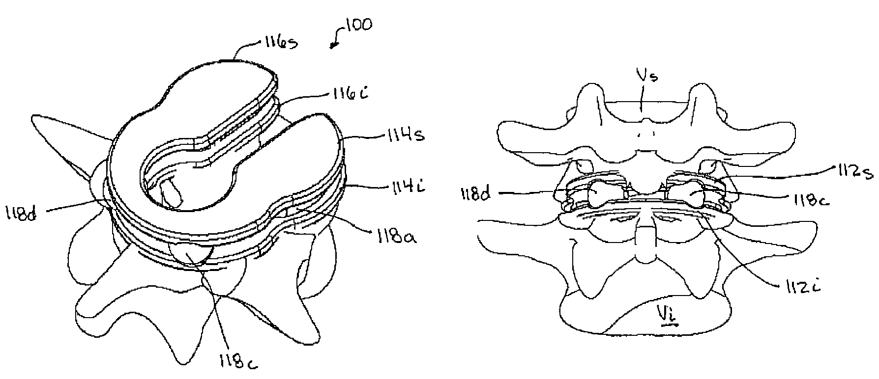 Multi-joint implant