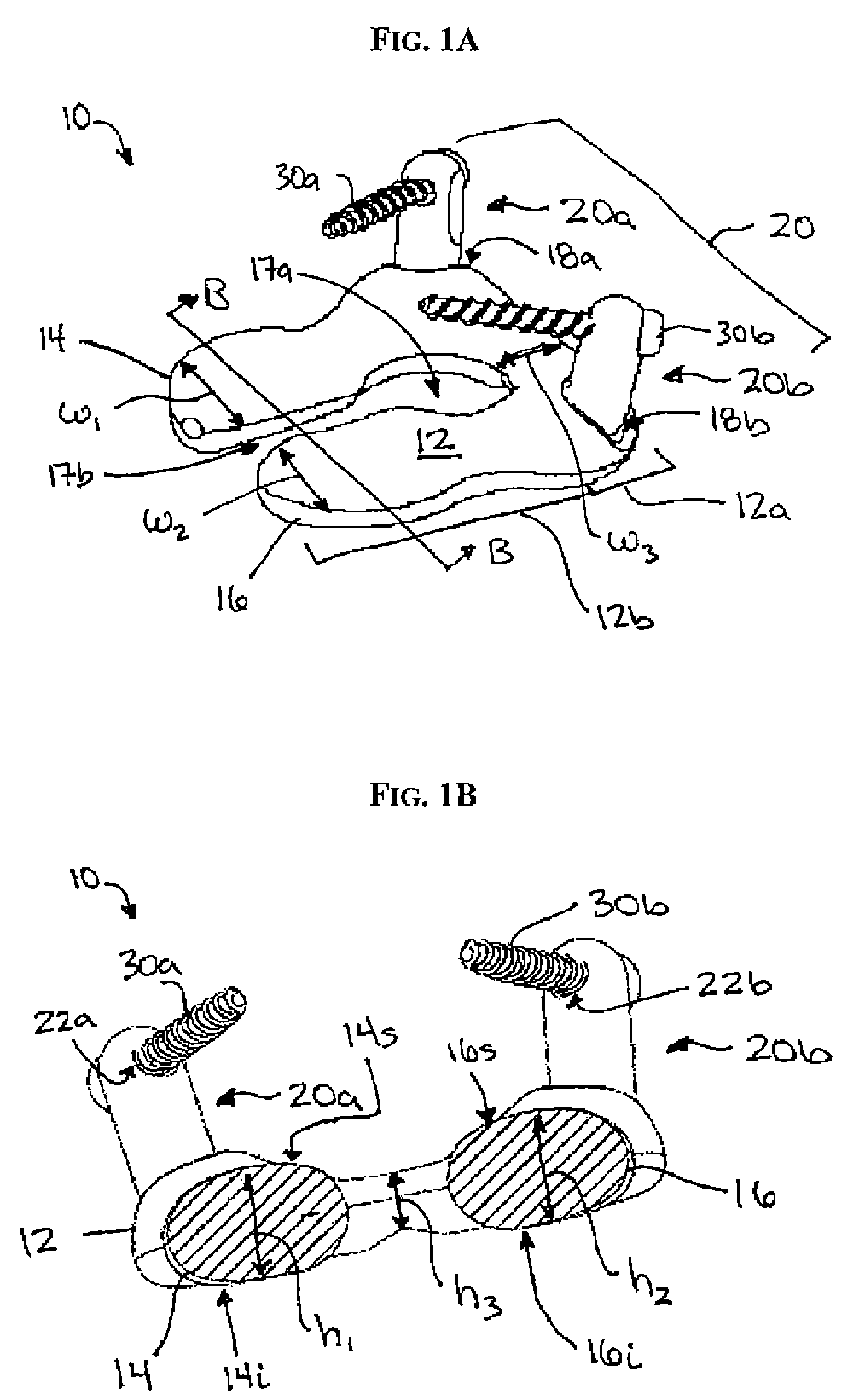 Multi-joint implant