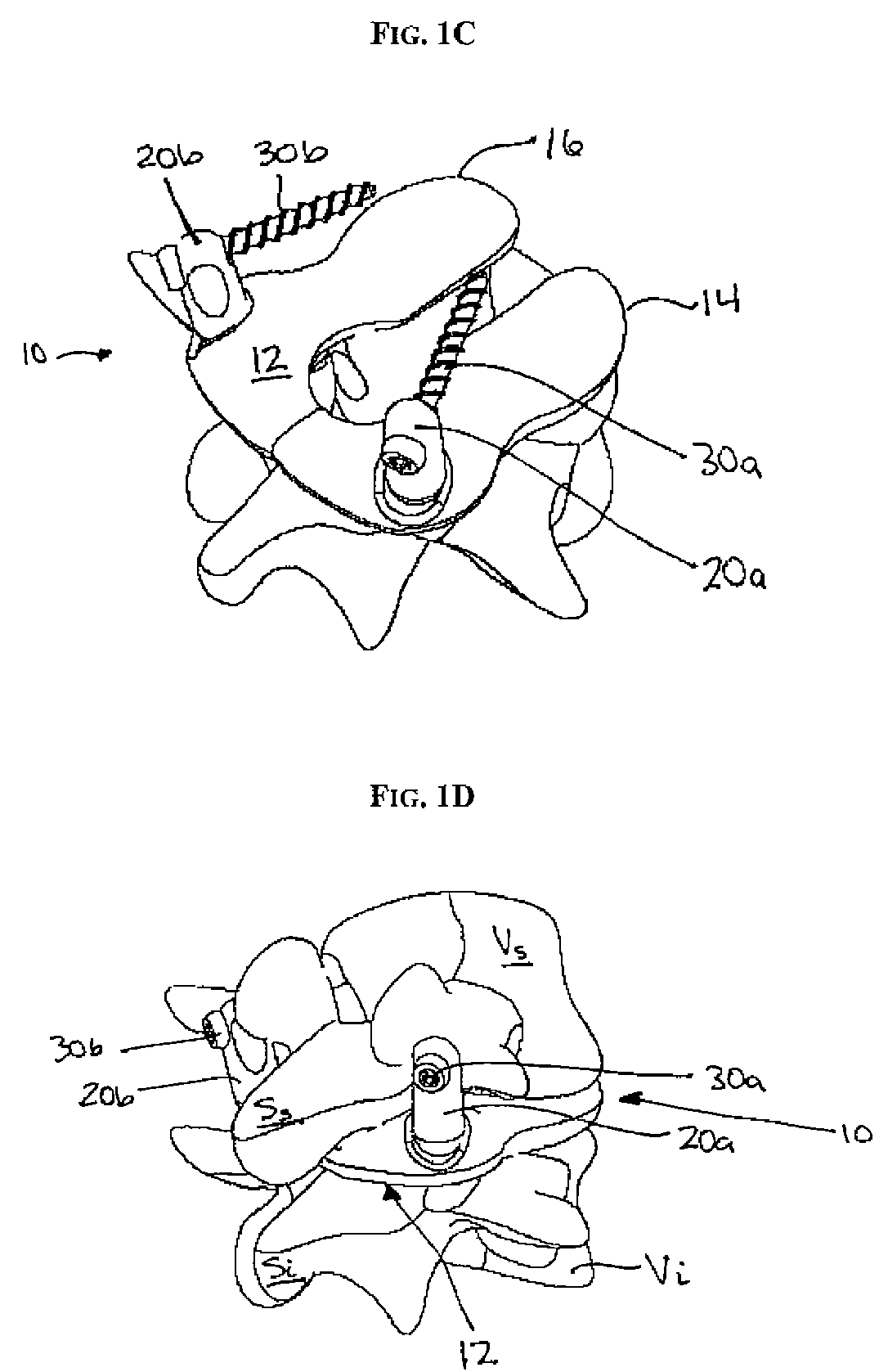 Multi-joint implant