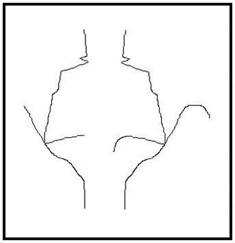 Image symmetry axis detection method based on edge line matching