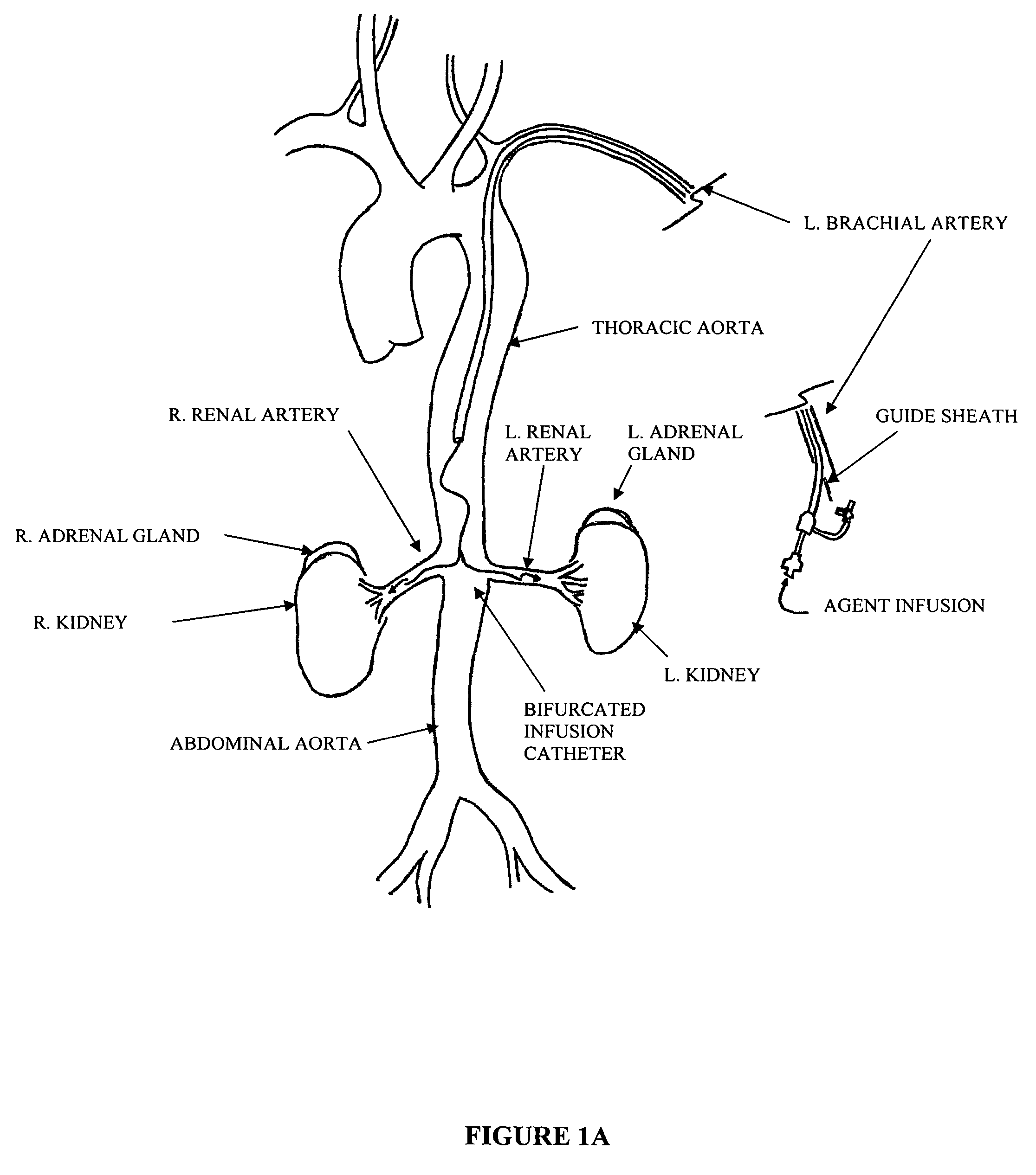 Bi-lateral local renal delivery for treating congestive heart failure and for BNP therapy