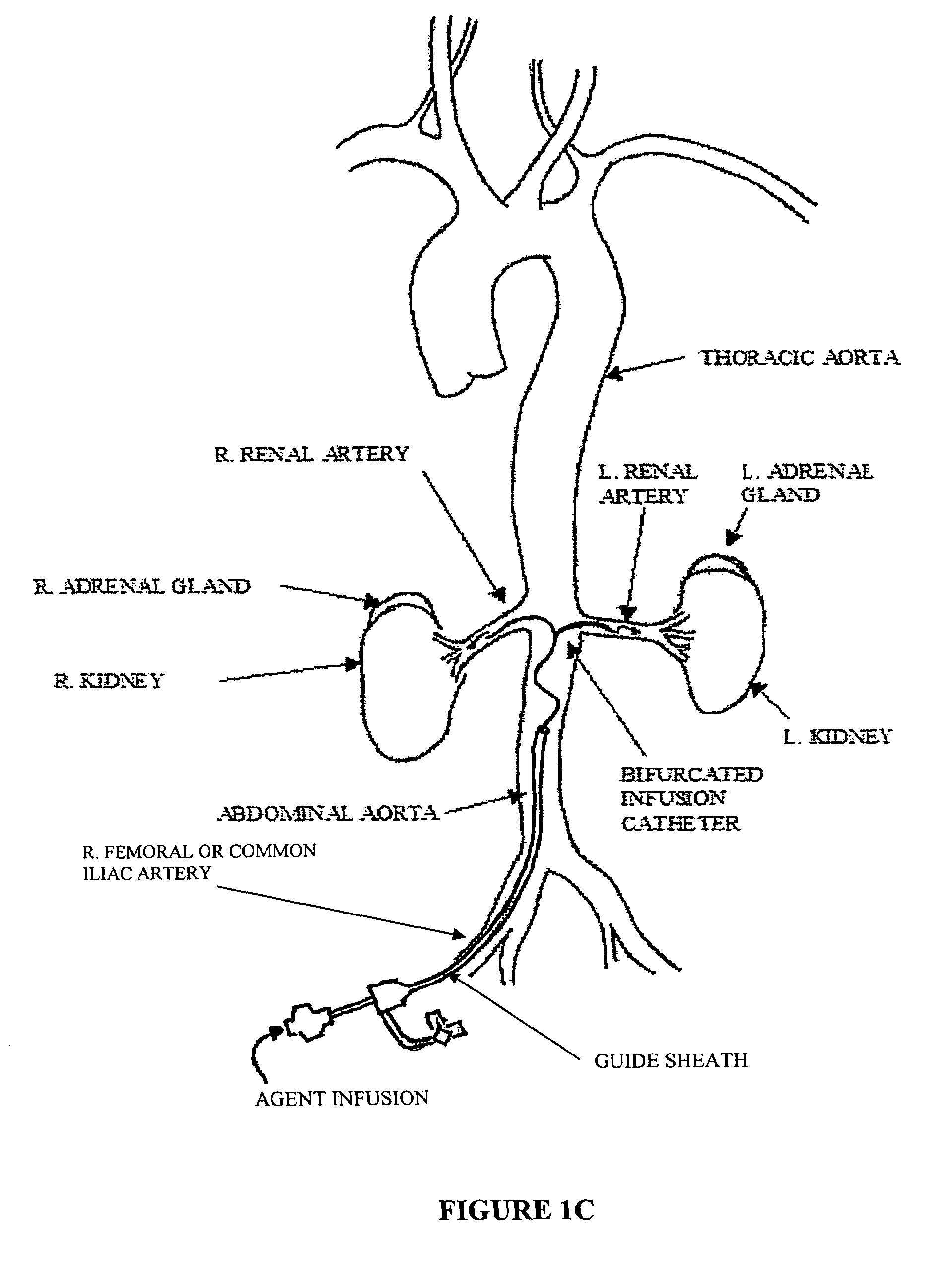 Bi-lateral local renal delivery for treating congestive heart failure and for BNP therapy