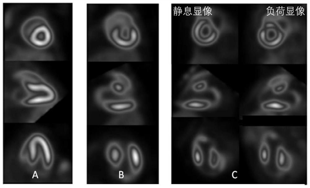 Preparation method and application of pyridazinone myocardial perfusion PET radiopharmaceutical