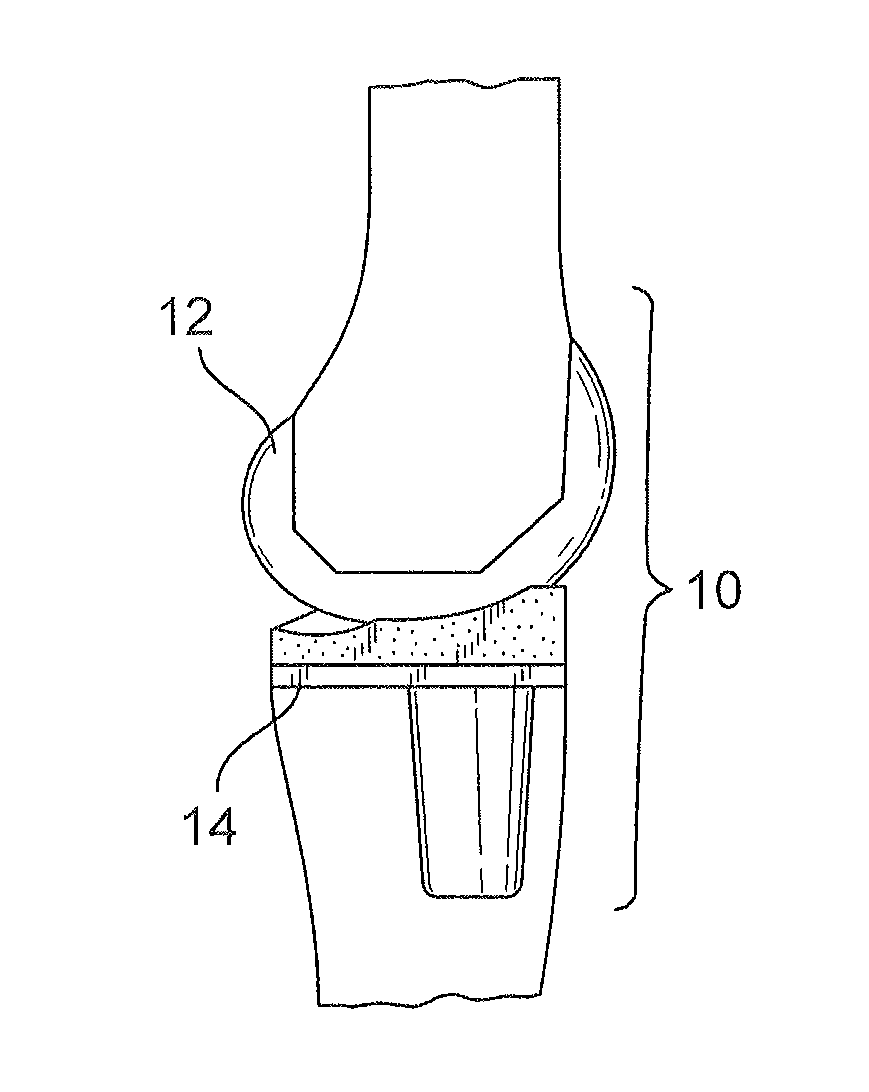 Systems and methods for providing a femoral component