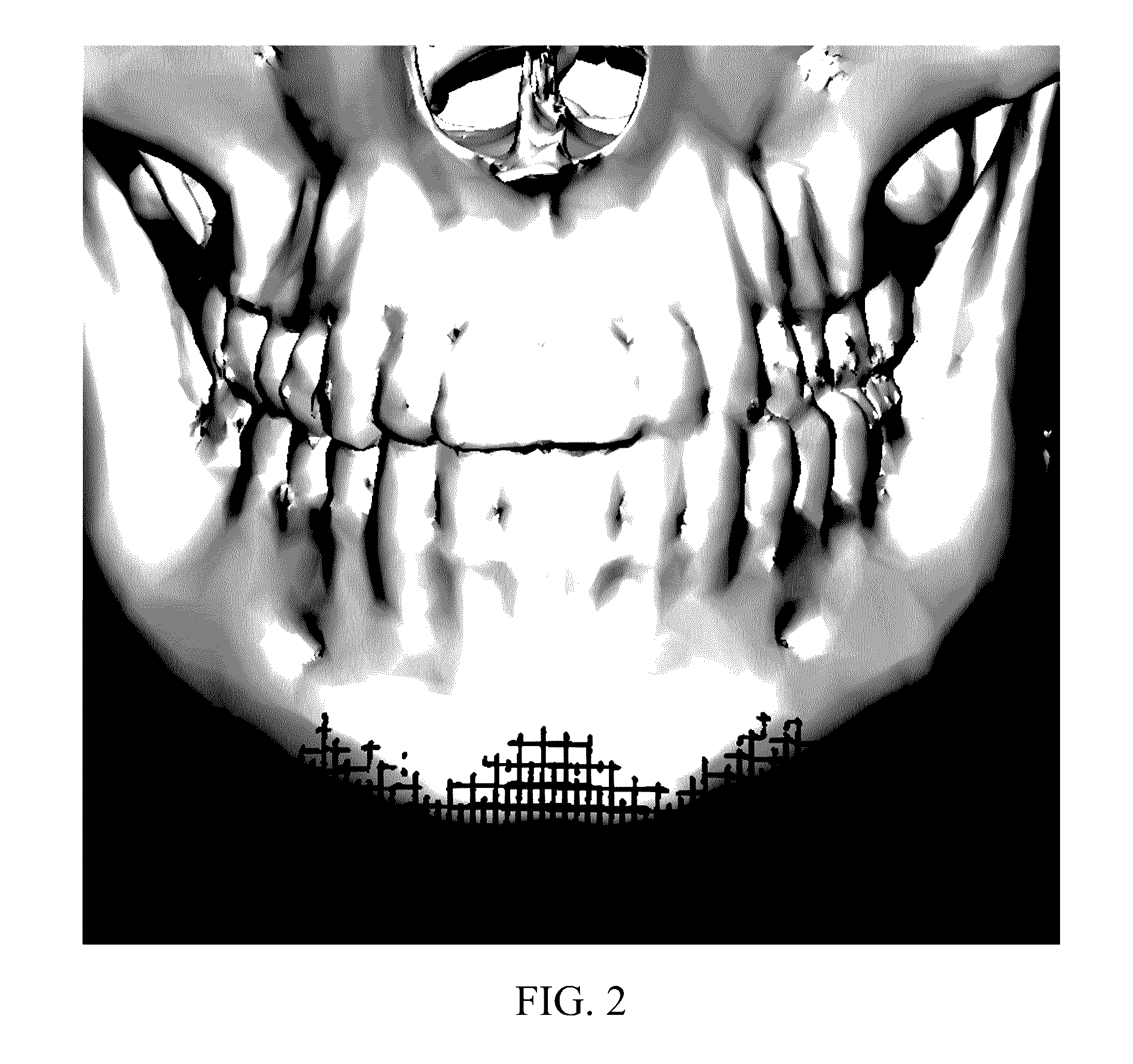 Osteoconductive and osteoinductive implant for augmentation, stabilization, or defect reconstruction